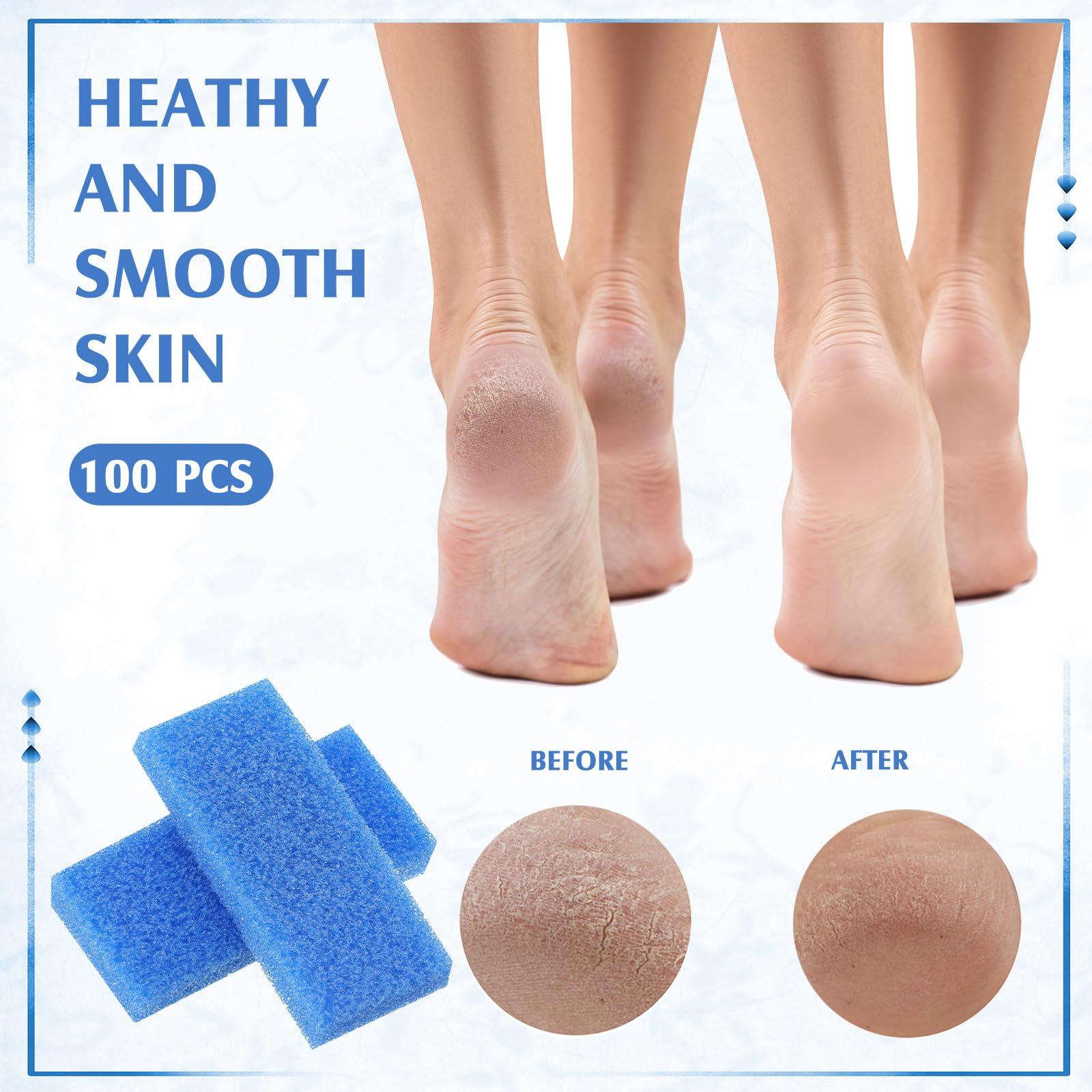 Batiyeer Batiyeer 100 Pcs Pumice Stone for Feet Scrubber Dead Skin Disposable Foot Pumice Foot Shower Scrubber Foot Scrubber for Heel Cuticle Callus Remover Bath Spa (Blue)