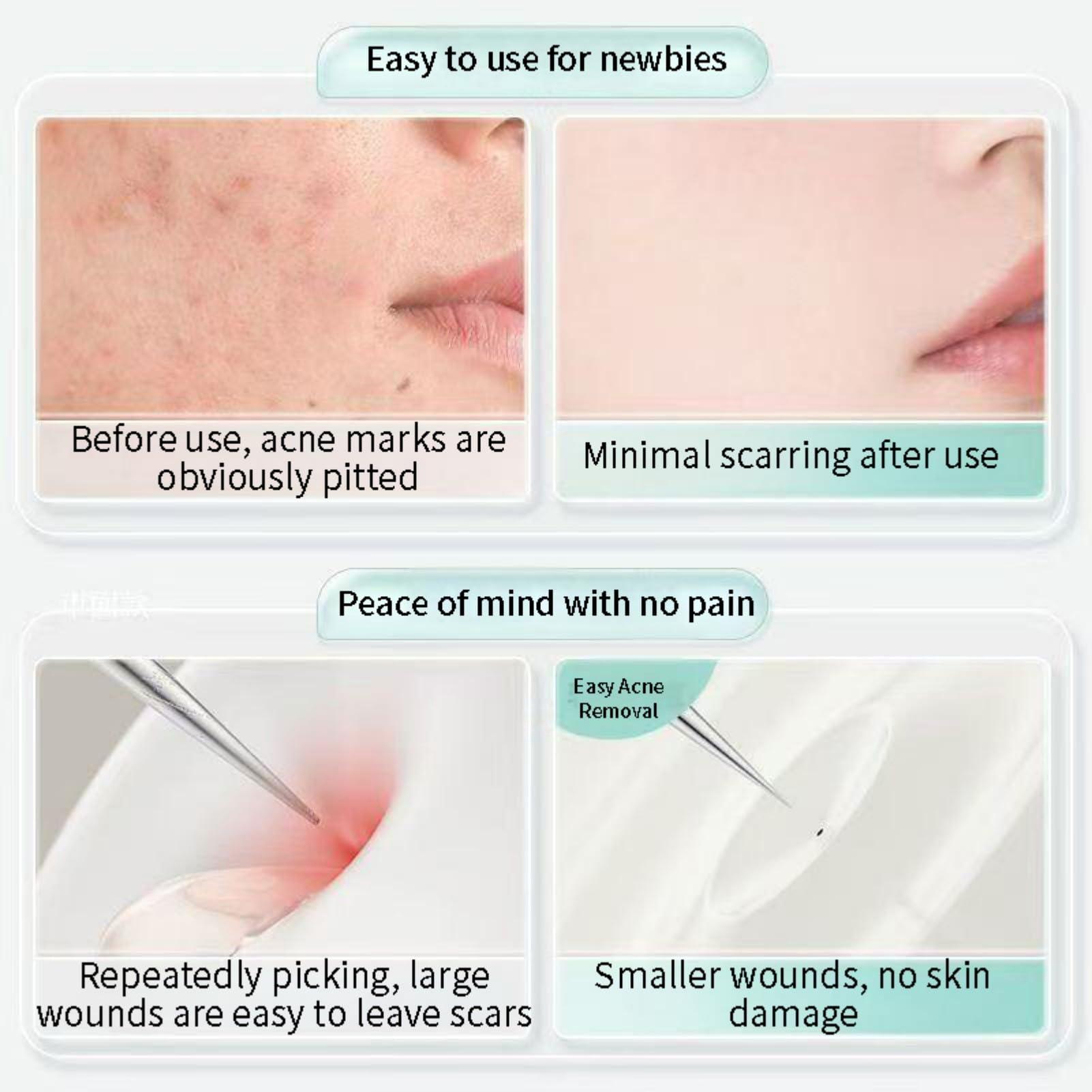 Mrchrogge Mrchrogge Facial Blackhead Remover Tweezers,Stainless Steel Portable Acne Needle Double Head,Squeeze Pick Acne Blackhead Needle Acne Needle Acne Needle (Pink)