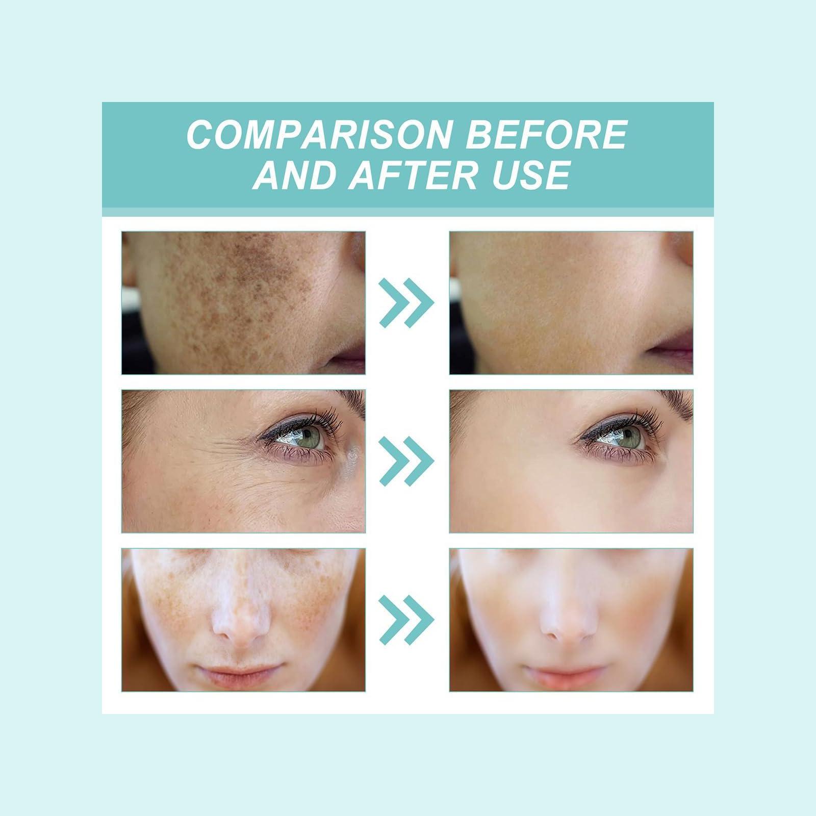 generic Dark Spot Remover for Face And Body, Dark Spot Remover (1)