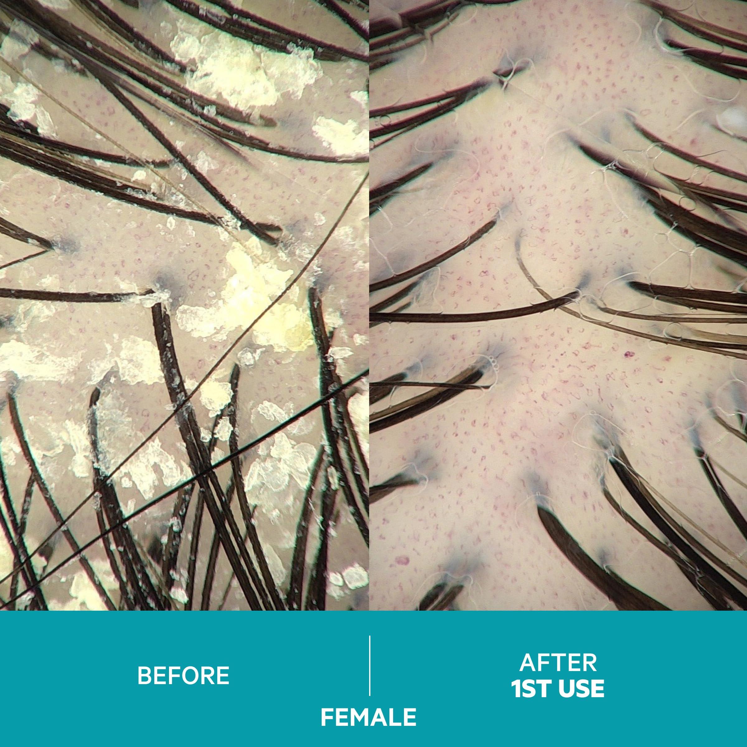 DS LABORATORIES DS Laboratories Dandrene Anti Dandruff Shampoo - Exfoliating Shampoo for Dry Itchy Scalp, Dandruff Scalp Treatment, Seborrheic Dermatitis & Psoriasis