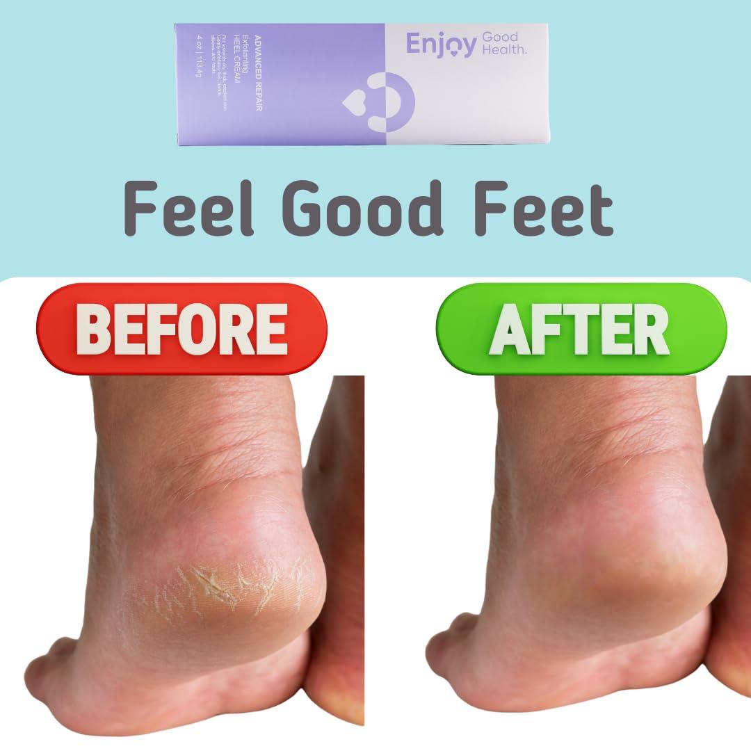 Enjoy Good Health. Enjoy Good Health. Urea 40% Cream for Dry, Cracked, Rough Feet, Hands, Elbows, Knees. Softens calluses and repairs skin barriers. Moisturizes and Hydrates.
