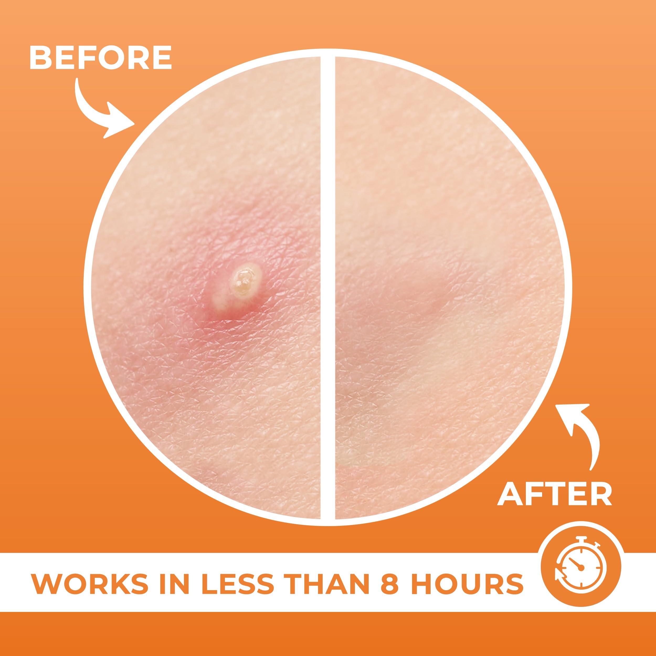 KEYCONCEPTS PatchRx Pimple Patches for Face (240 Patches), Hydrocolloid Acne Patches, Pimple Patch Pimple Stickers, Hydrocolloid Patch Acne Dots Acne Pimple Patches For Face, Zit Patches, Acne Spot Treatment