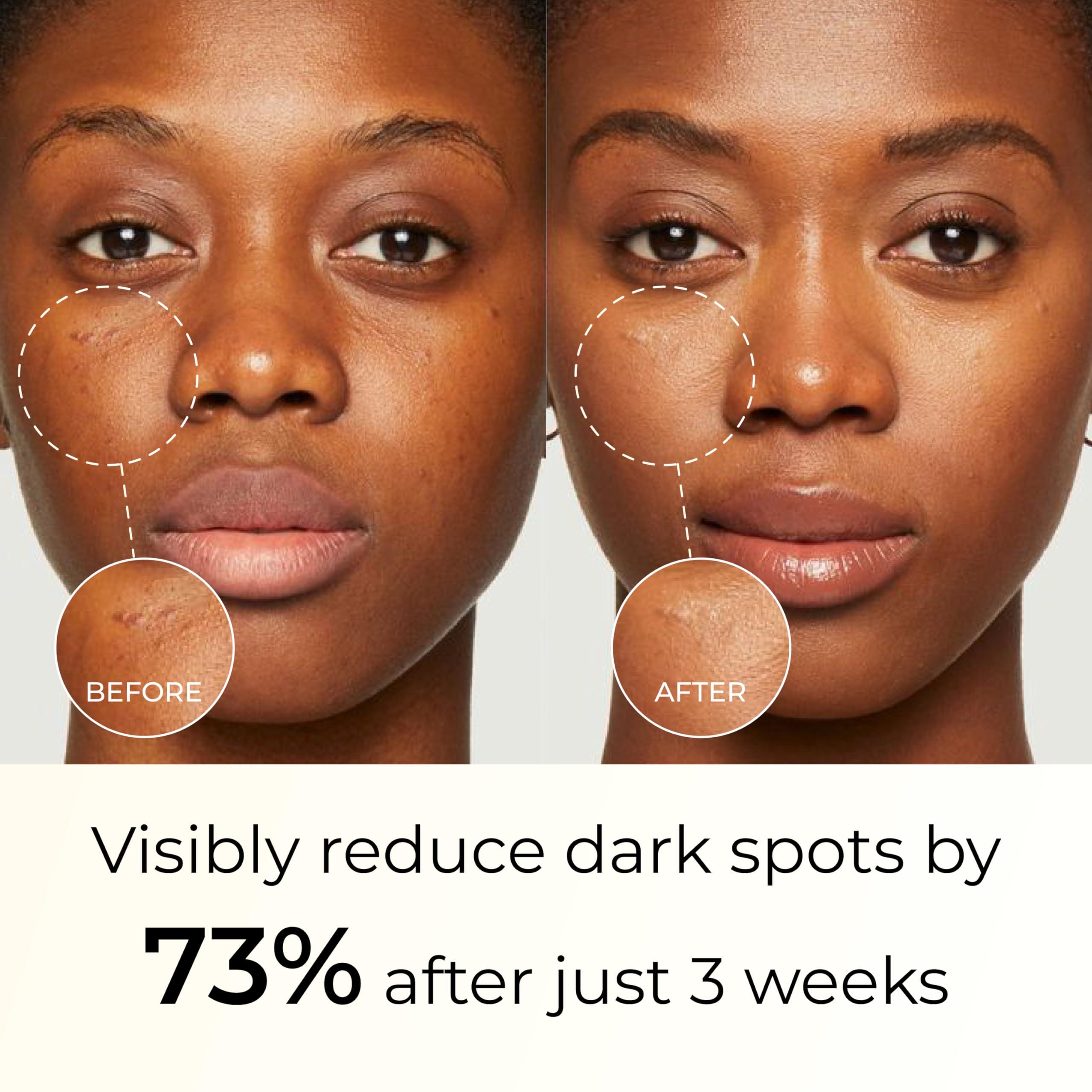 ABERA Abera Dark Spot Remover for Face: Dark Spot Corrector for Age Spot Sun Spot Freckles Melasma Brown Spot - Faded Spot Correcting Cream for Face Hands (2 Boxes)