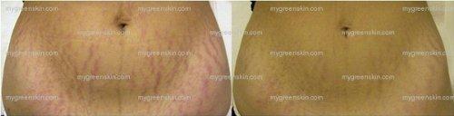 Green Skin Organix Best STRETCH MARK Complete Solution Kit- Medical grade microdermabrasion crystals mixed with Raw Cocoa Butter +organic 15 natural oils blend Stretch Mark COMPLETE KIT Microdermabrasion Crystal Butter & Green15 Oil shown to prevent and remove old stre