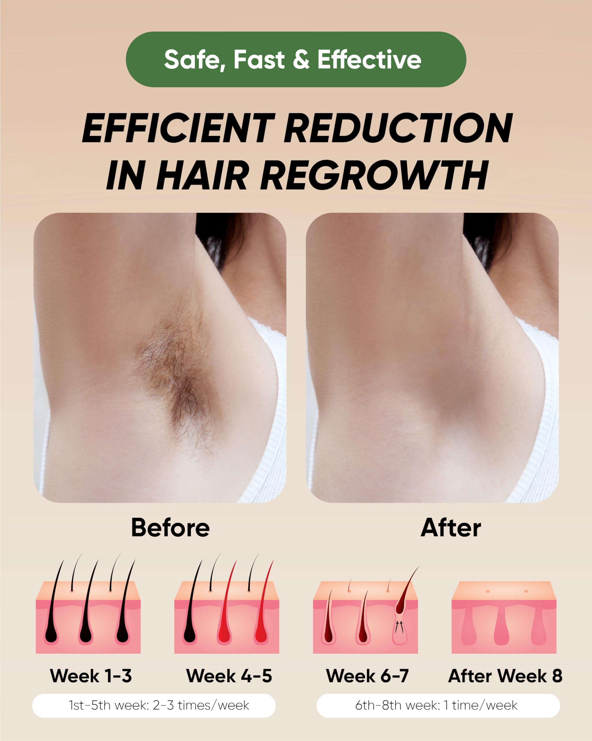 XSOUL XSOUL At-Home IPL Hair Removal for Women and Men Permanent Hair Removal 999,999 Flashes Painless Hair Remover on Armpits Back Legs Arms Face Bikini Line, Corded