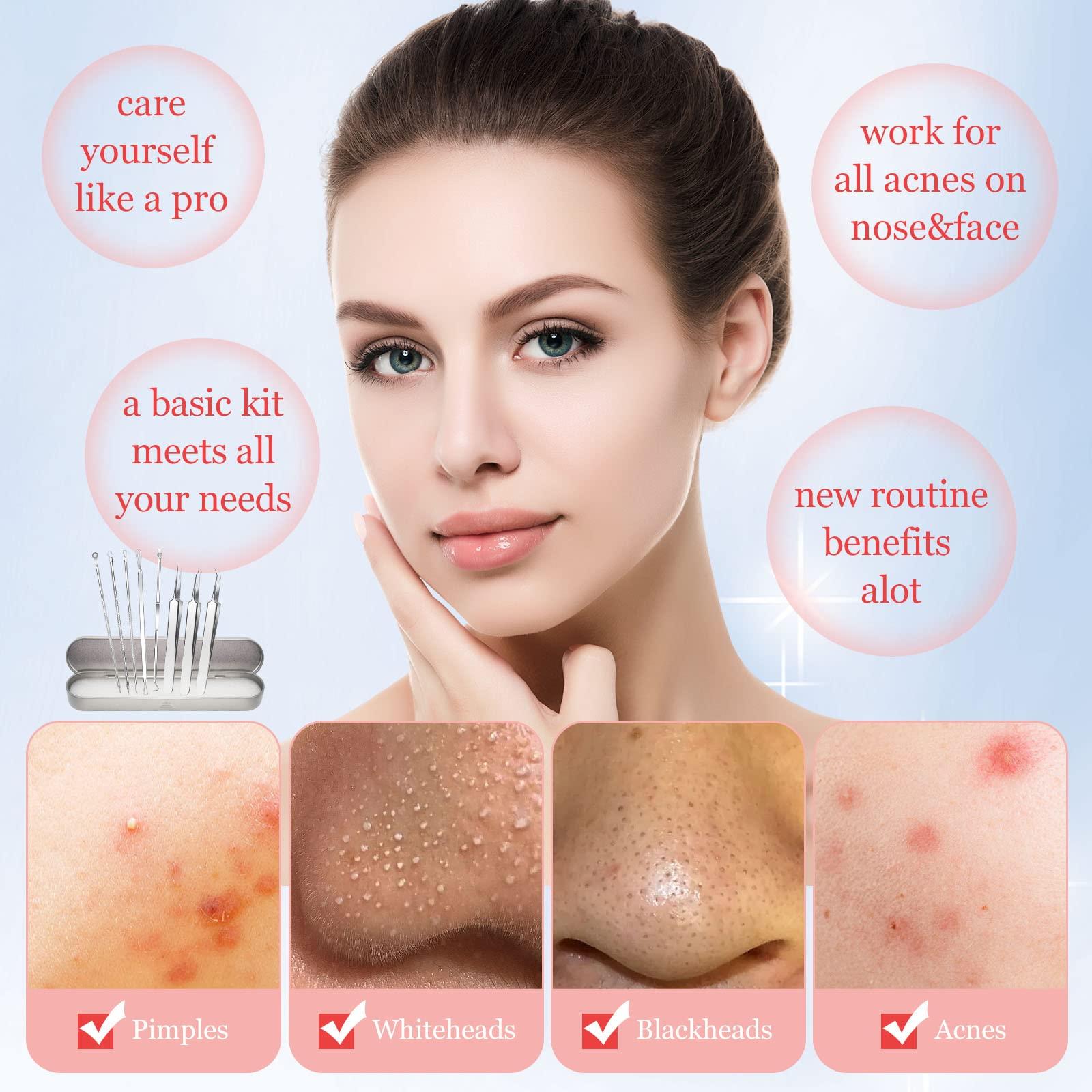 ritarga Blackhead Remover 8PCS Stainless Steel Pimple Popper Tool Kit with Portable Metal Case Whitehead Blemish Removal Tool