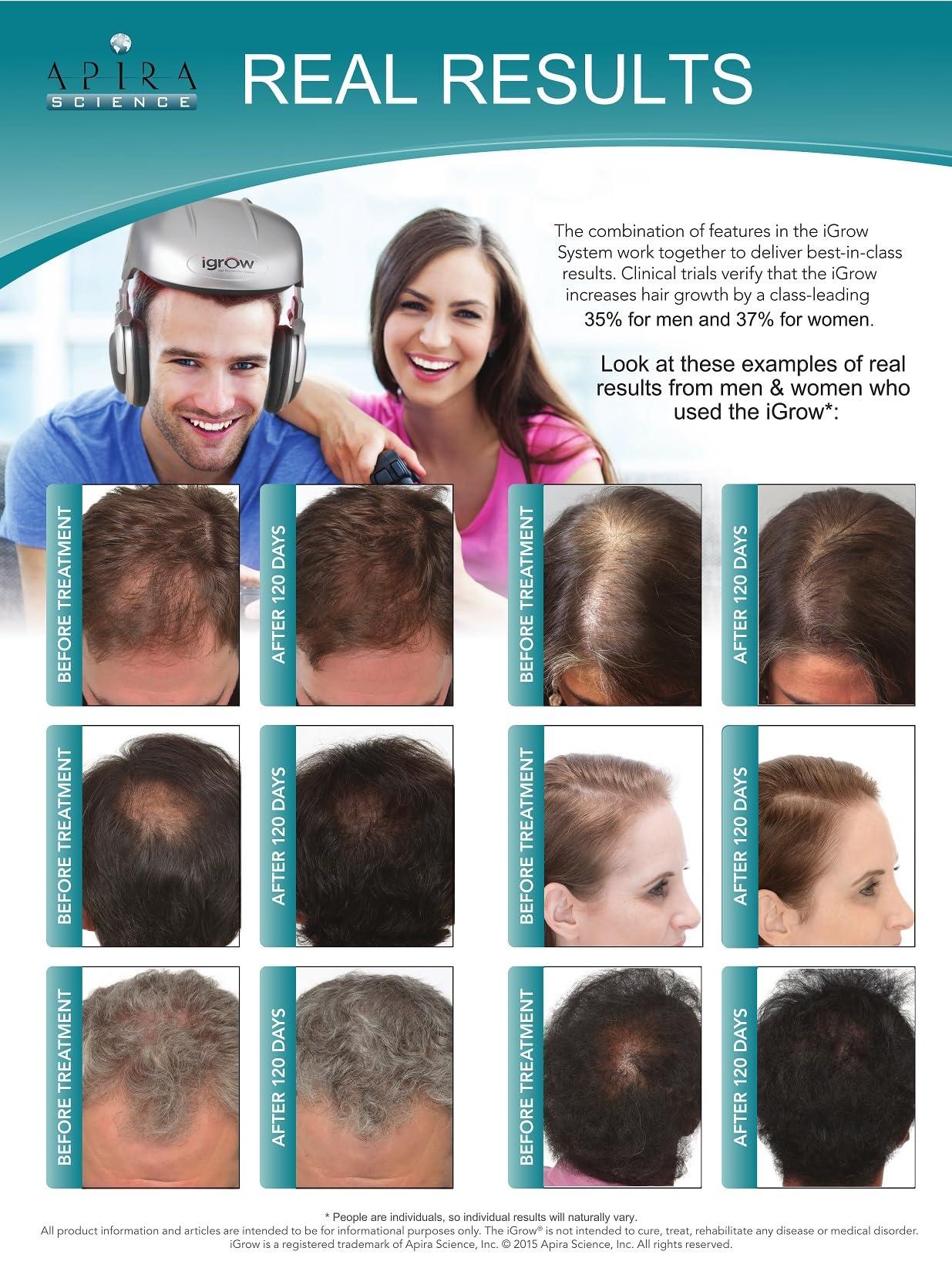 iGrow iGrow Laser Hair Growth System - Clinically proven, FDA Cleared Laser Cap Hair Growth for Men & Women.