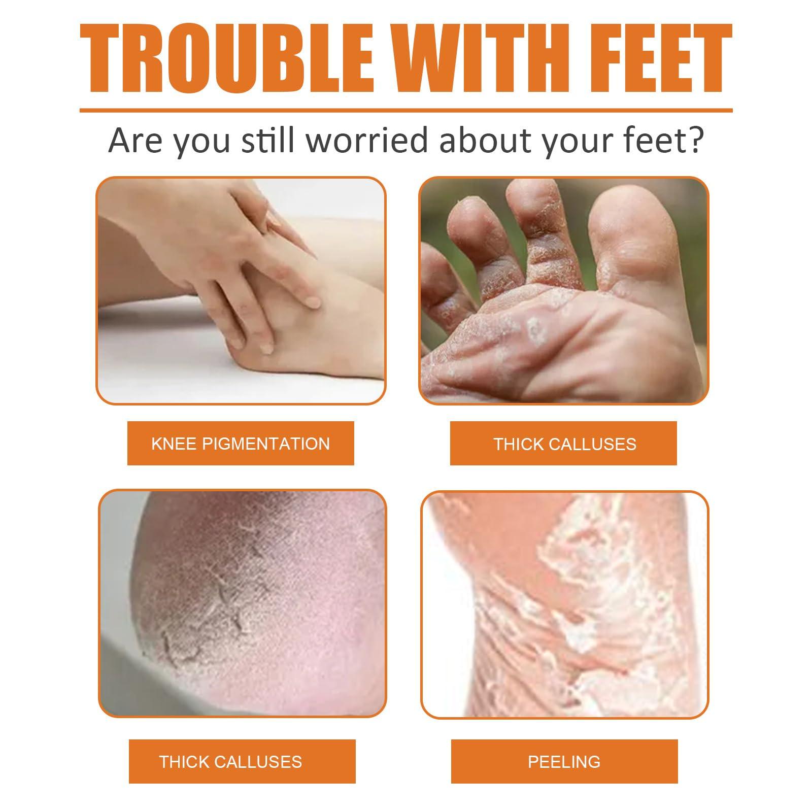 LOEBKE Foot Callus Removal Spray,Foot Heel Callus Remover Spray,Foot Peeling Spray Orange Oil,Foot Peel Spray That Remove Dead Skin,Exfoliating Peeling & Calluses On Feet (1PCS)