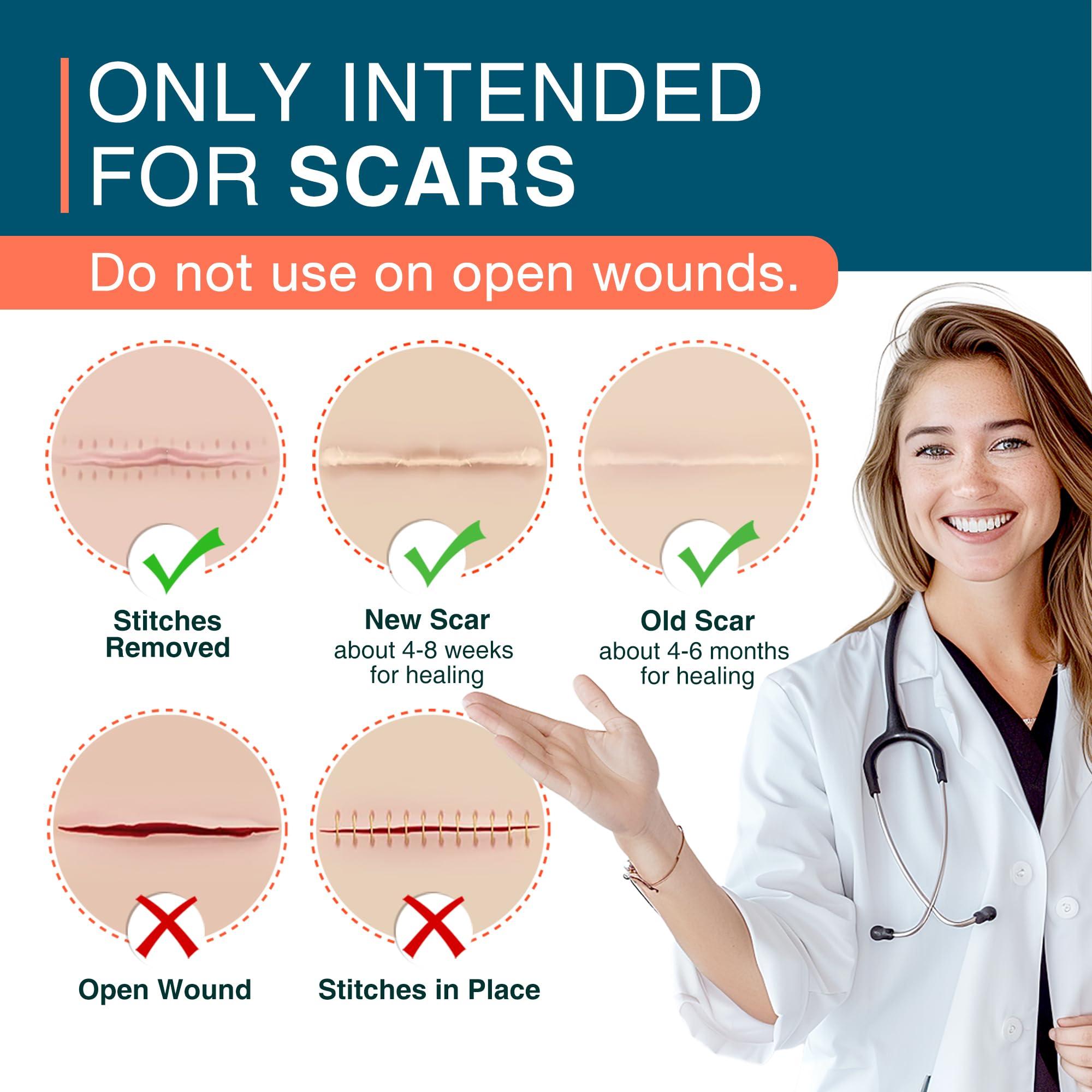 MEDLOT MEDLOT Silicone Scar Sheets, 1.5 x 156 Medical Silicone Scar Tape Roll, Reusable Scar Strips for Surgical, C-Section, Keloid Bump, Stretch Marks, Acne, Hypertrophic Scar Treatment