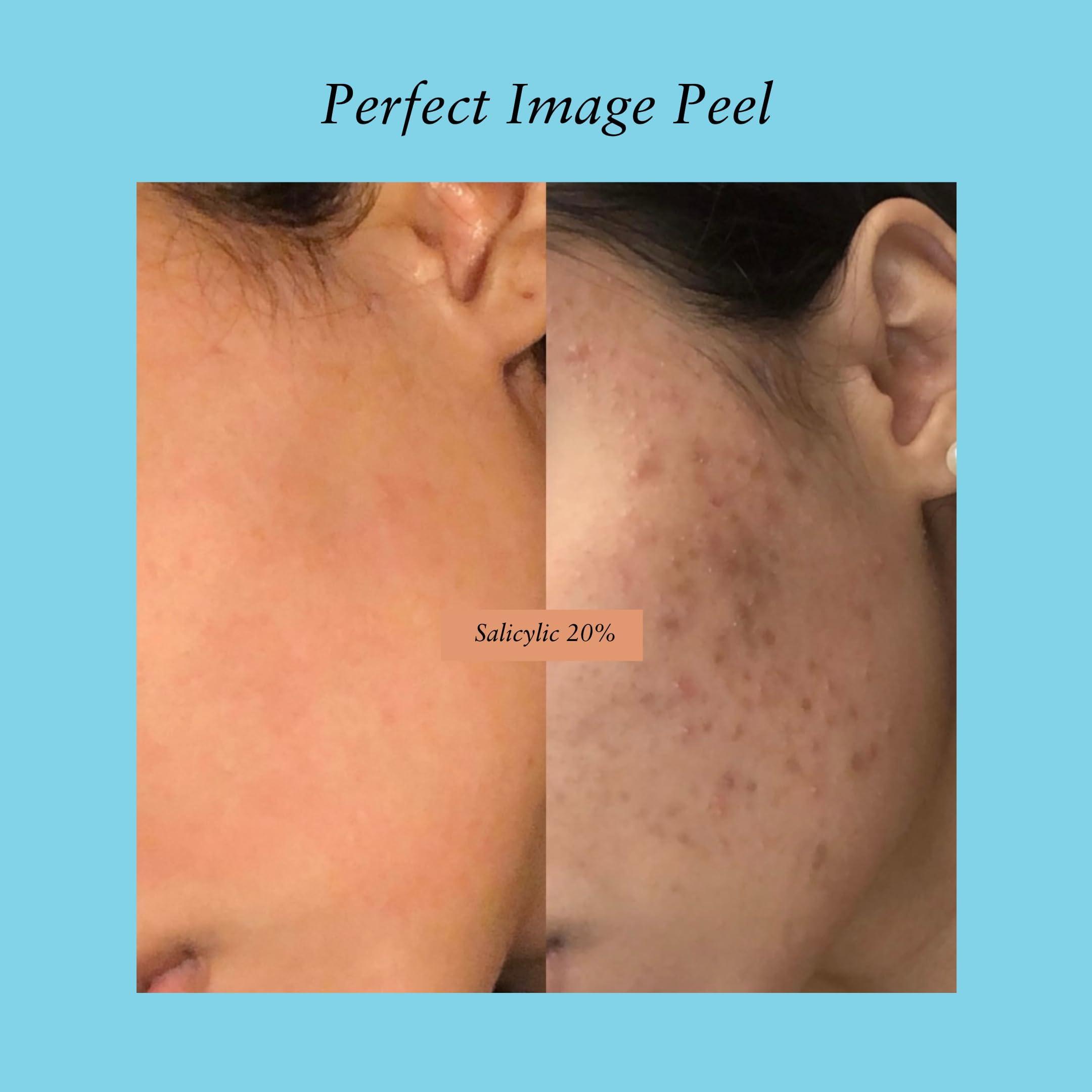 Perfect Image Salicylic Gel Chemical Peel - Enhanced with Green Tea Extract and Tea Tree Oil (20% Strength)
