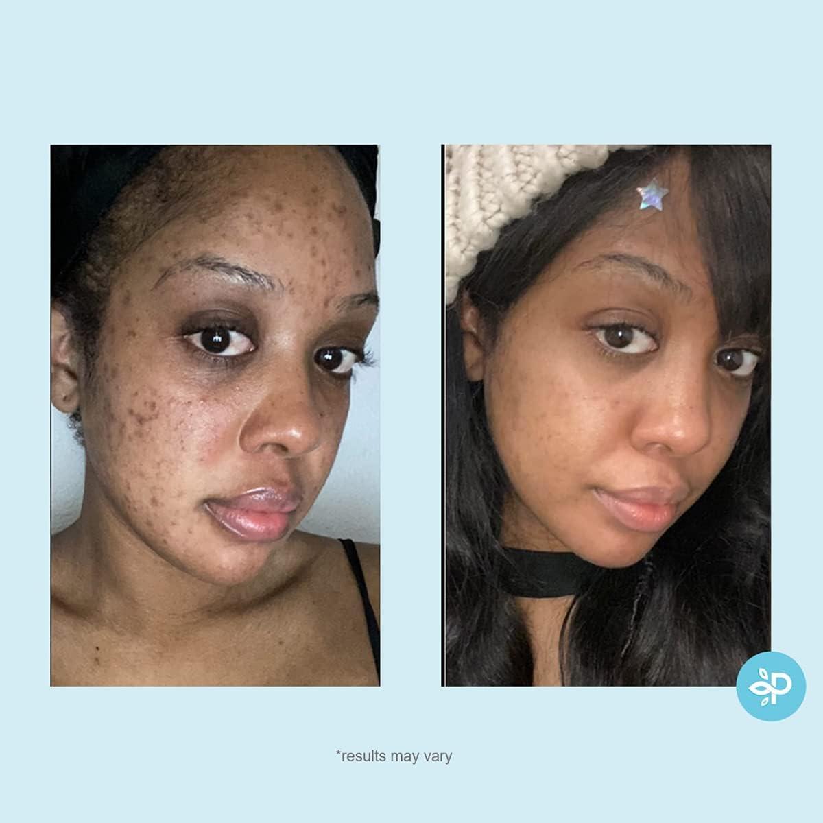 Perfect Image Salicylic 10% Gel Peel, Breakout and Pore Minimizer and Cleanser, 15-30 Full Facial Chemical Peels, 1 fl oz. e, 30 mL Perfect Image