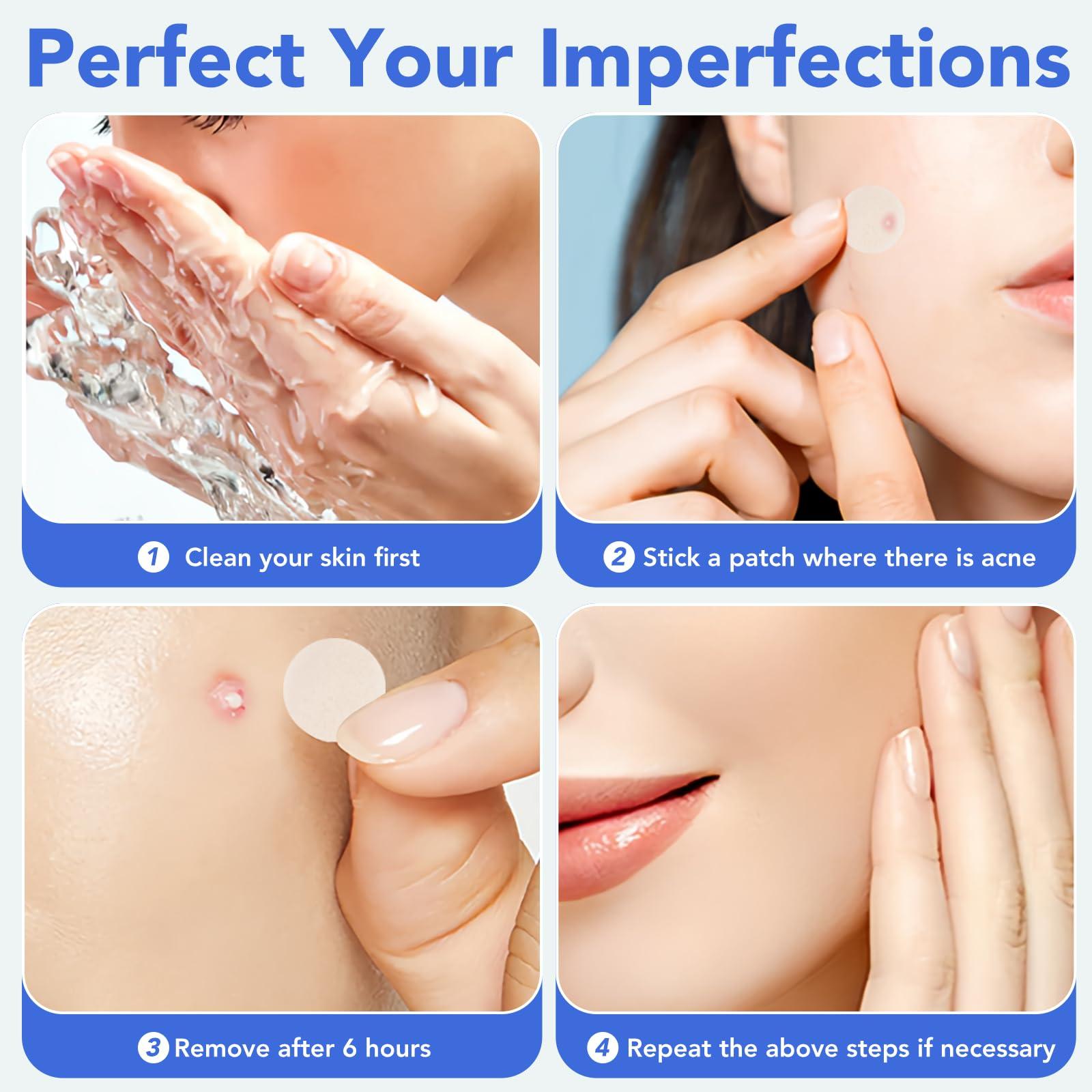 Qmakup Qmakup Pimple Patches for Face,Acne Patches for Face,Pimple Patch,Zit Patches,Hydrocolloid Blemish Patches for Covering Zits and Blemishes,with Salicylic Acid,Tea Tree oil & Calendula oil, 108 Counts