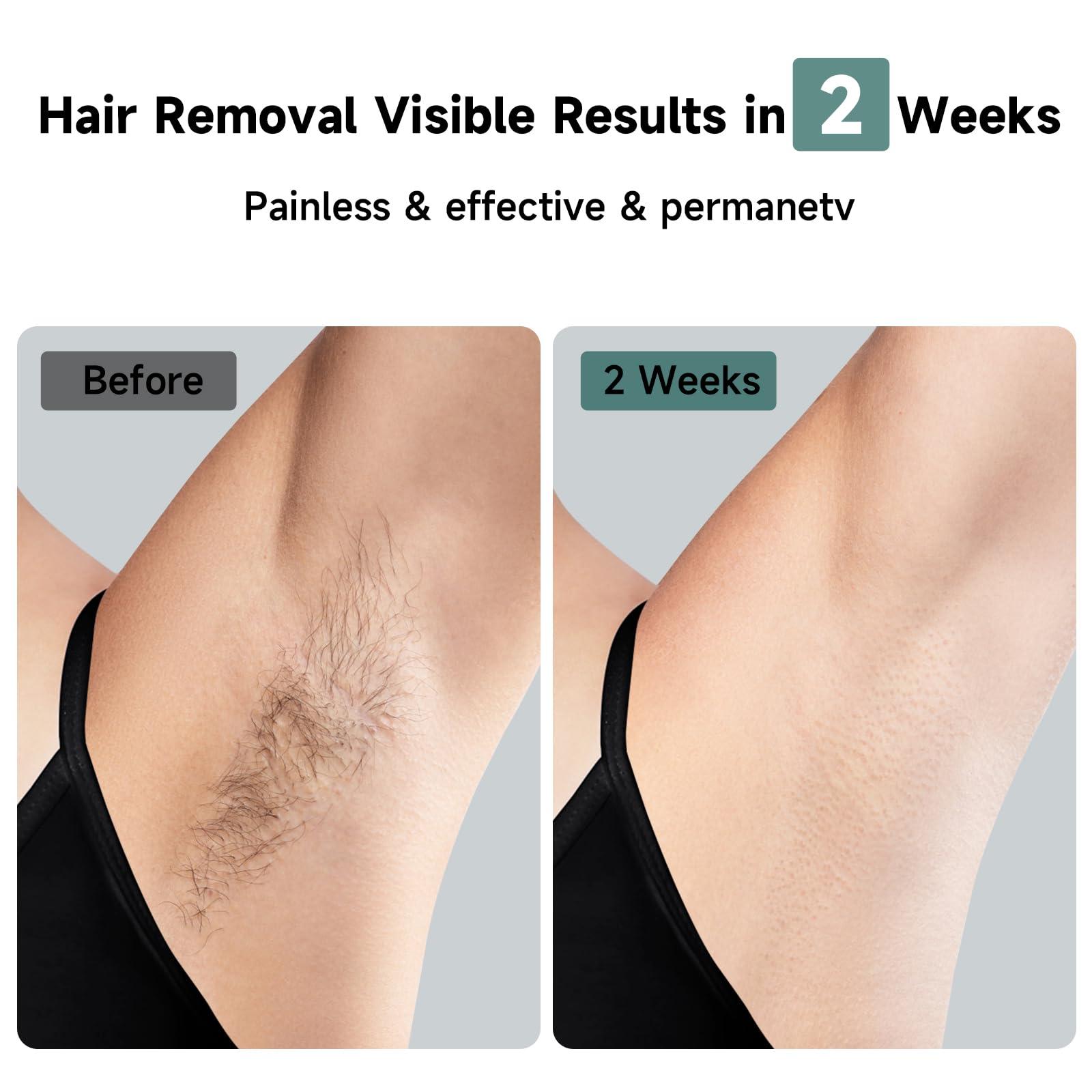 JOVS JOVS Laser Hair Removal, 37F Painless Hair Removal Device with Sapphire Ice-Cooling, 3 in 1 Hair Removal & Skin Rejuvenation for Women and Men, 8 Modes Skin Care for Whole Body, Touch Screen