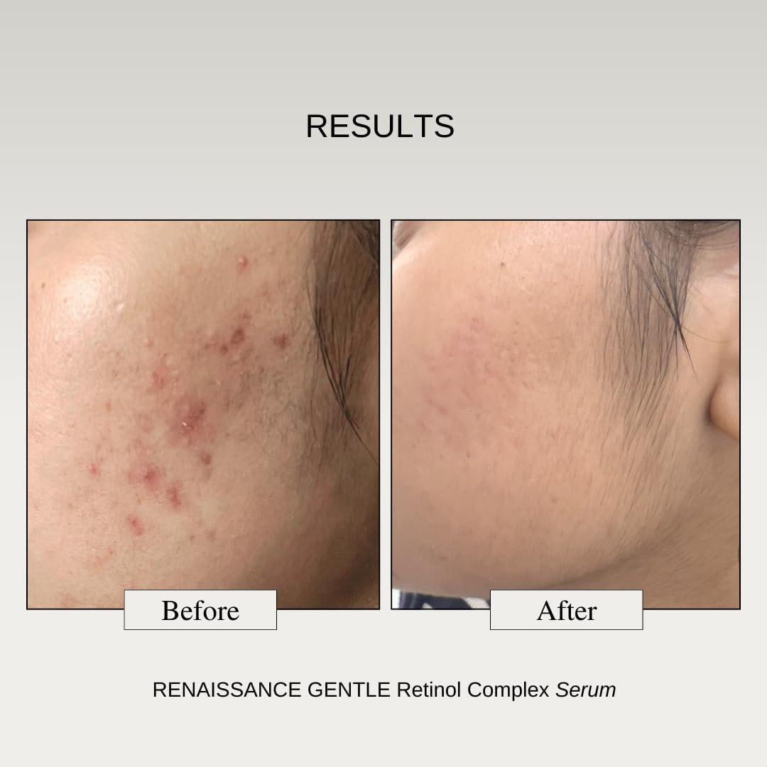 Oxygen Magnesium Private Limited The Formular\'x 0.1% Retinol + 0.5% Granactive Retinol Gentle Complex Serum With Niacinamide & Bakuchiol | For Acne, Acne Marks, Dark Spots, Wrinkles, & Pores Brightening Face Serum 30G