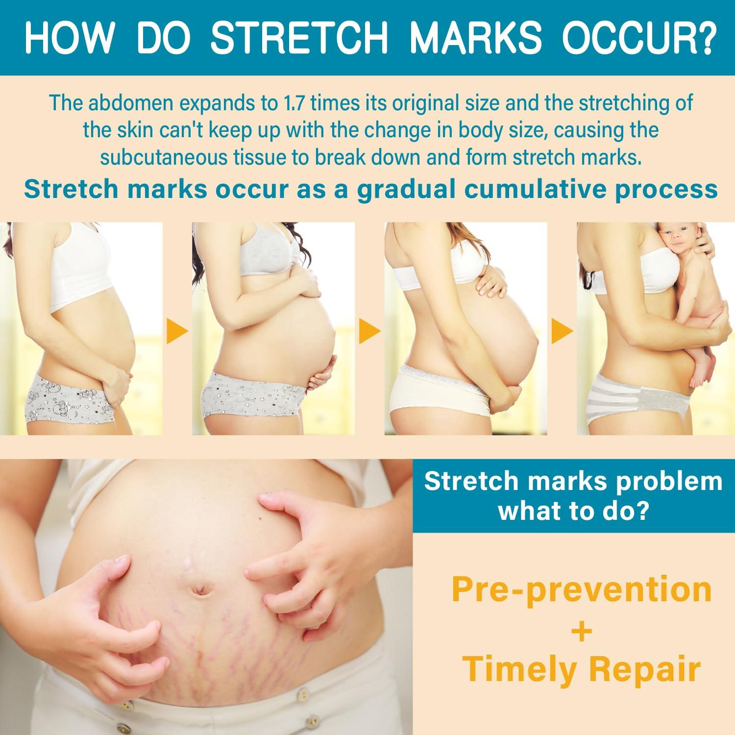 AOAO PEGO Stretch Marks Oil Maternity Body Oil for Stretch Marks Pregnancy Skin Care oil, Prevention & Reduction of Stretch Marks Pregnancy, 4.06 oz (2pcs)