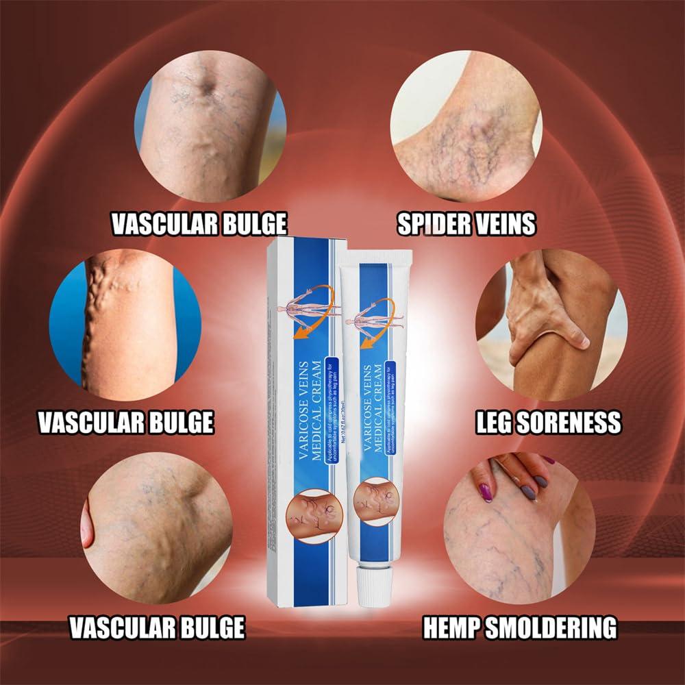 Nosbei Vericose Veins Treatment Blue Light Lazer Treatment Pen, Varicose Veins Blue Light Therapy Set, Blue Light Therapy Pen for Varicose and Spider Veins, Spider Vein Removal Lazer Pen (2cream+1pen)