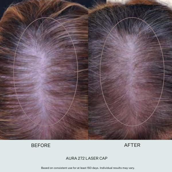 scalp delivery Scalp Delivery Aura 272 Diode Laser Cap - FDA Cleared Low-Level Red Light Laser Therapy (LLLT) Hair Growth Cap for Men & Women, Full Scalp Treatment to Reverse Thinning