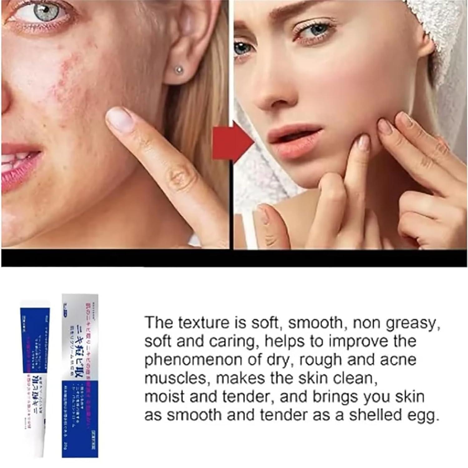 getuse Lion Pair Acne Cream, 20g | Natural Acne Gel for Face | Japanese Moisturizing Treatment for Women & Men | 3pcs (1pc)