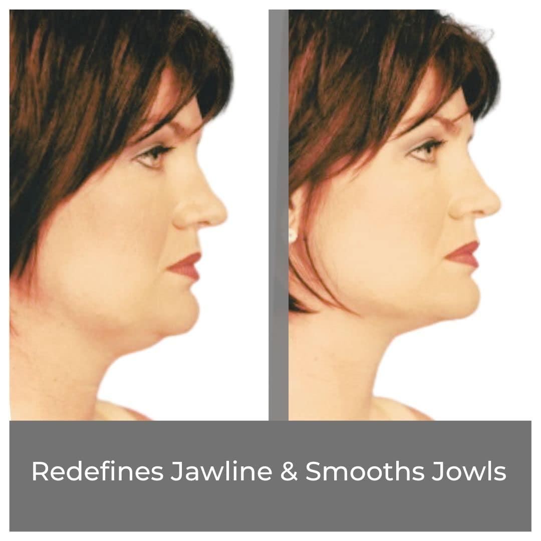 Bring It Up Bring It Up Instant Face Lift Tape Kit: 30-Day Supply, Transparent Neck & Eyebrow Lift Strips, Anti-Wrinkle Stickers, Face Tape Instantly Lifts Sagging Skin Around Face, Hides Double Chin-Made in USA