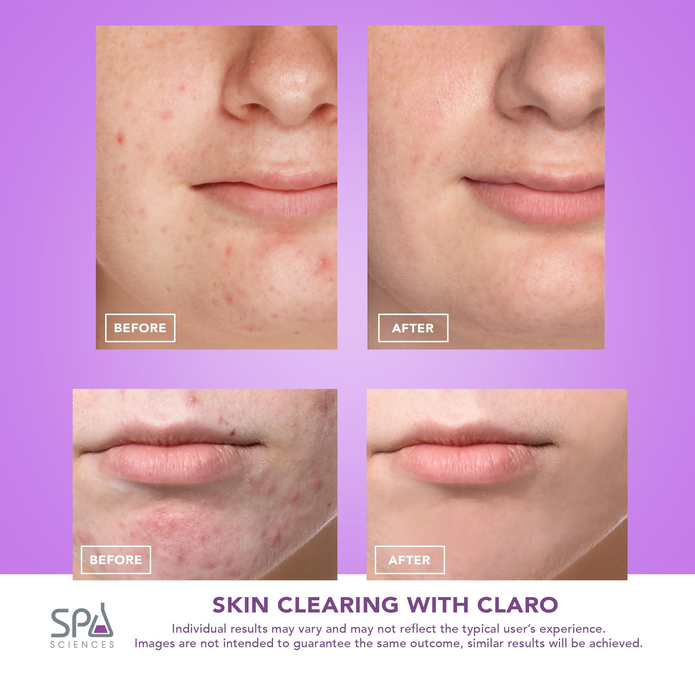 SPA SCIENCES Spa Sciences CLARO Clinically Proven Blue & Red LED Acne Treatment Light Therapy System-FDA Cleared-Rechargeable- Professional Home Acne Healing/Clearing Treatment