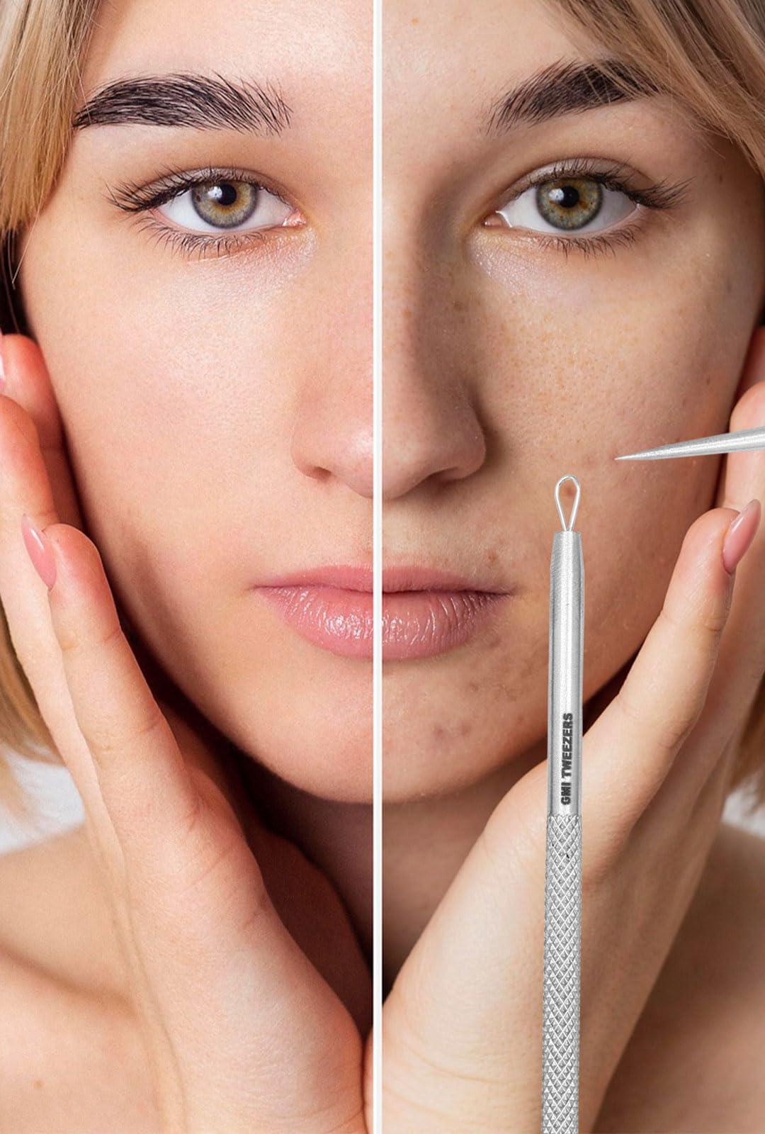 GMI-TWEEZERS GMI-TWEEZERS Blackhead Remover- 5 Piece Blackhead Extractor Tools Set for Pore Vacuum Extraction- Professional Grade Facial Cleaning & Blemish Removal- Blackhead Extractor Tools.