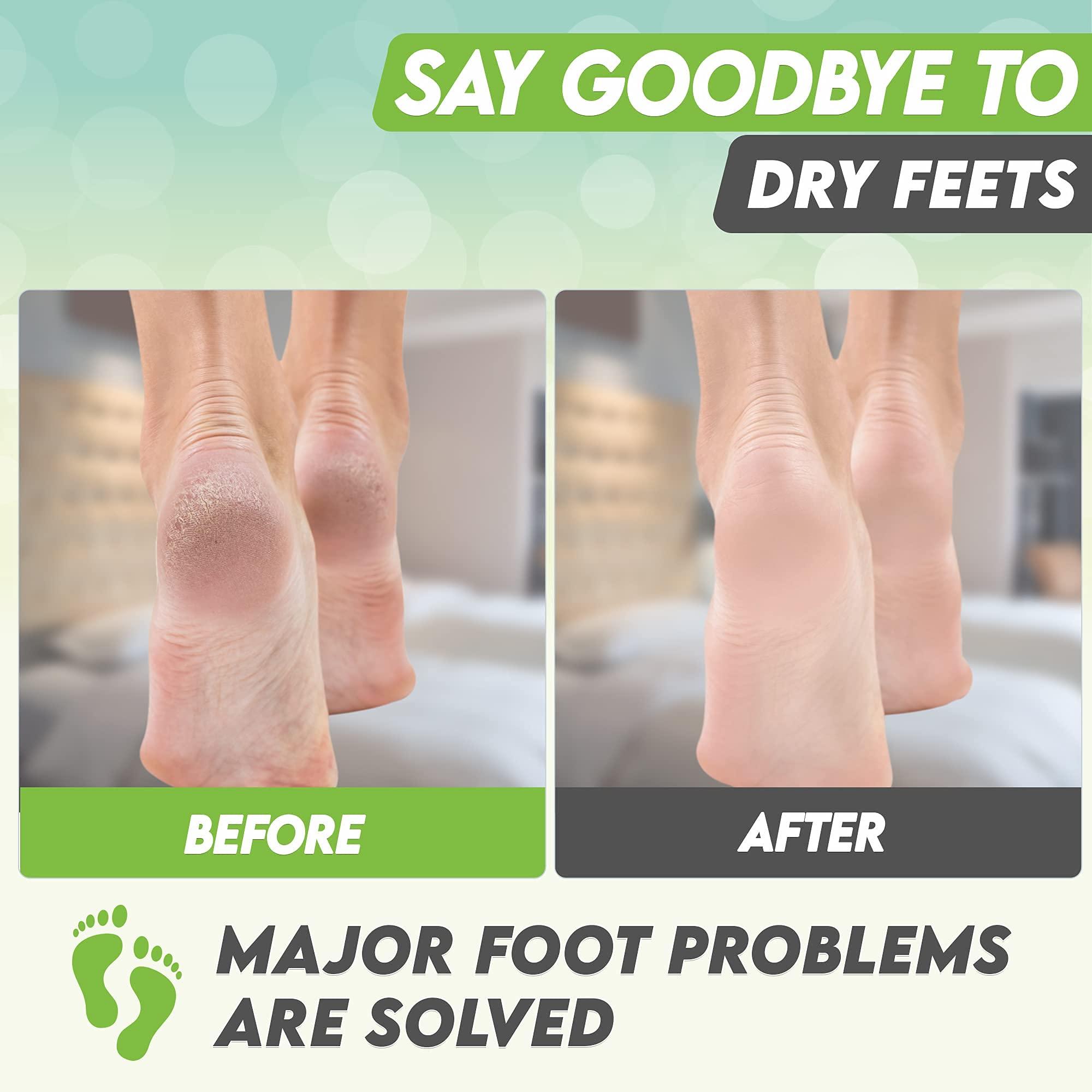 karma organic Foot Peel Mask Green Tea Moisturizing Exfoliating Foot Masks - Karma Organic Feet Peeling Masks for Dry ed Feet, Remove Dead Skin & Calluses - Removes & Repairs Rough Heels, Dry Toe Skin (Pack of 2)