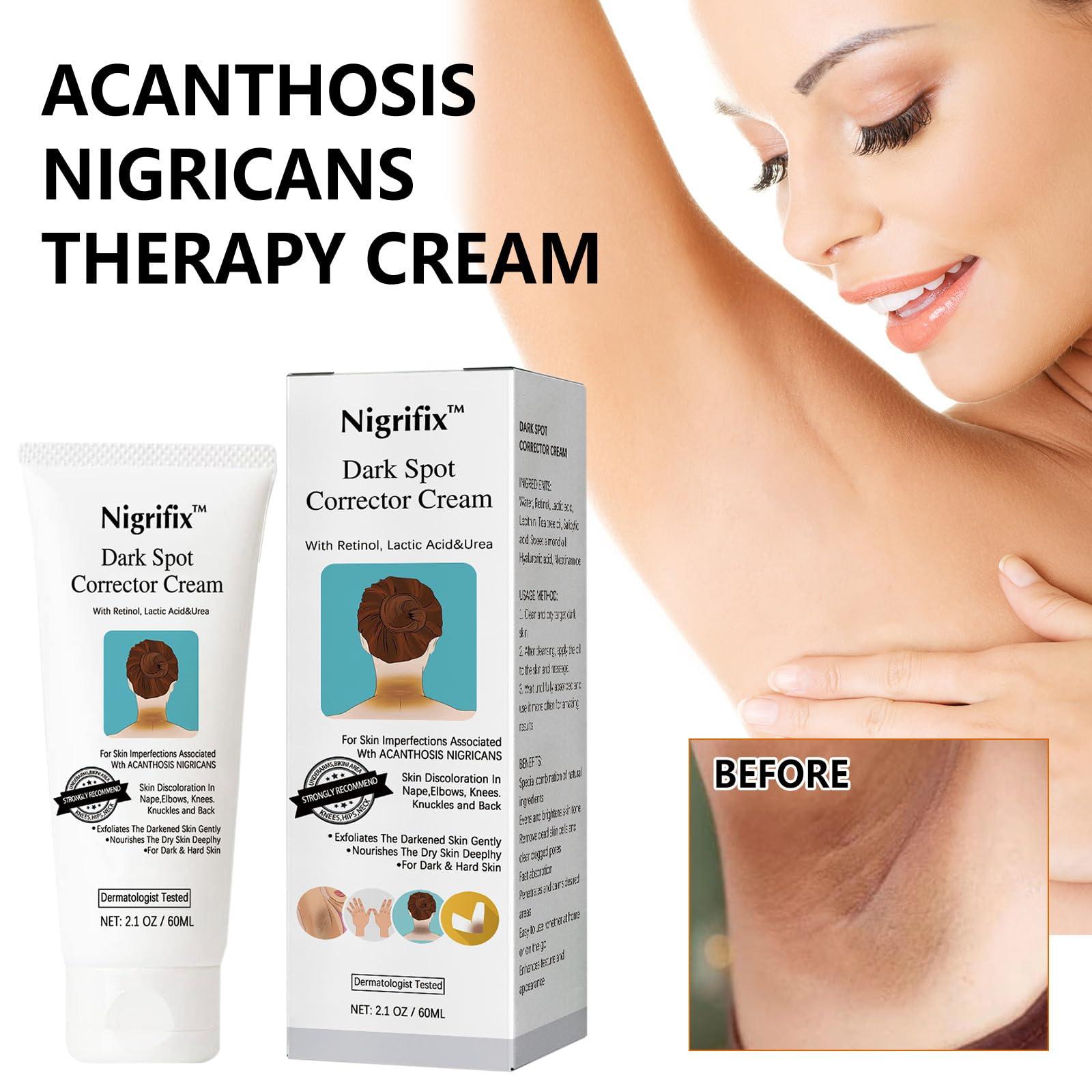 Nigrifix Nigrifix Acanthosis Nigricans Therapy Cream,Dark Spot Remover For Body,Dark Spot Corrector Cream,- Underarm, Neck, Armpit, Knees, Elbows, Private Areas, Intimate Areas - Upgraded Formula, 2.1Fl Oz