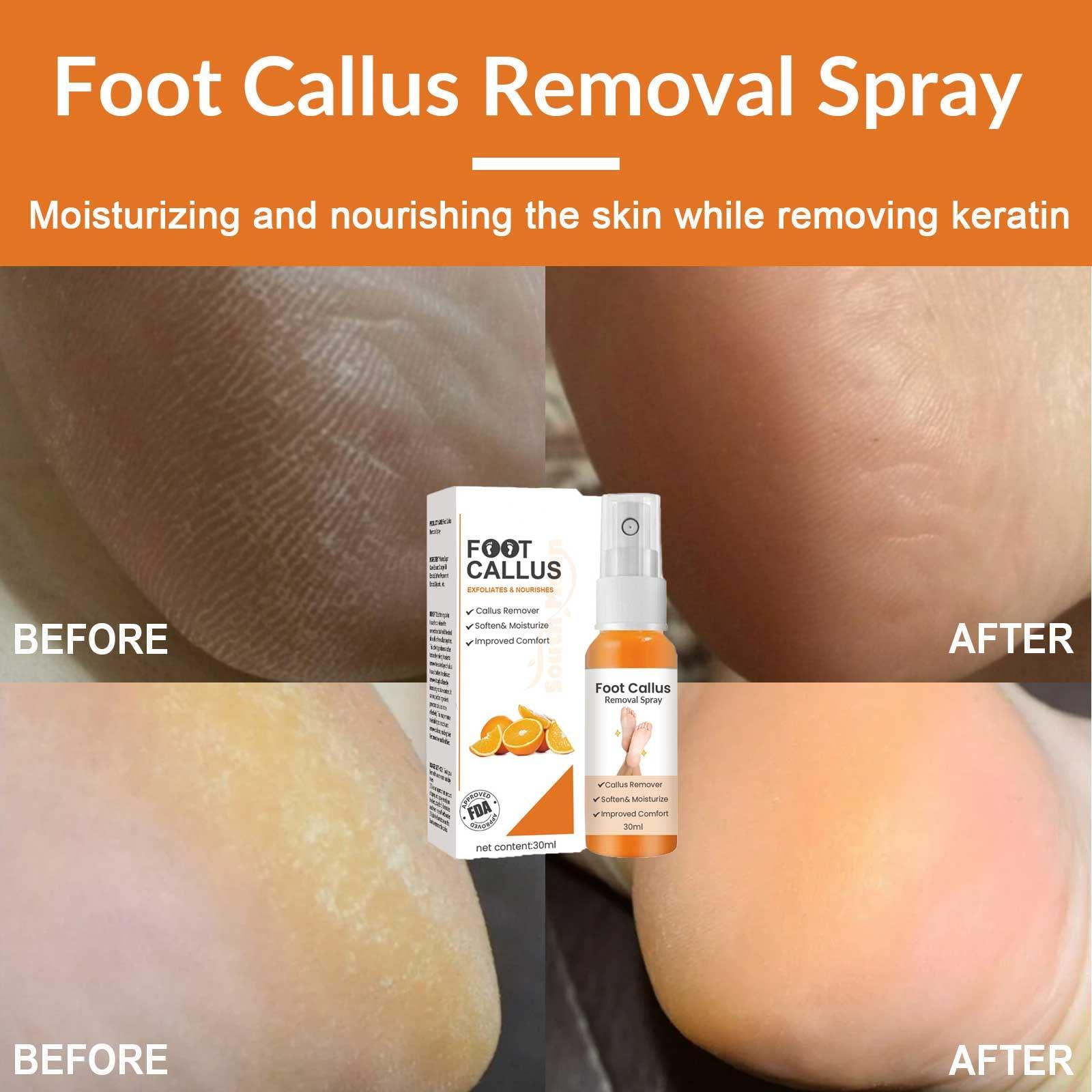 LOEBKE Foot Callus Removal Spray,Foot Heel Callus Remover Spray,Foot Peeling Spray Orange Oil,Foot Peel Spray That Remove Dead Skin,Exfoliating Peeling & Calluses On Feet (1PCS)