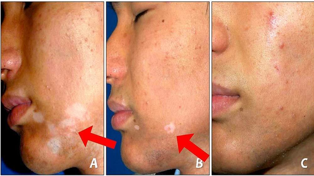 Fiico Melgain Lotion for Vitiligo/White Patches: Decapeptide : Stimulates Pigmentation 10ml (Pack OF 2) - With Express Shipping