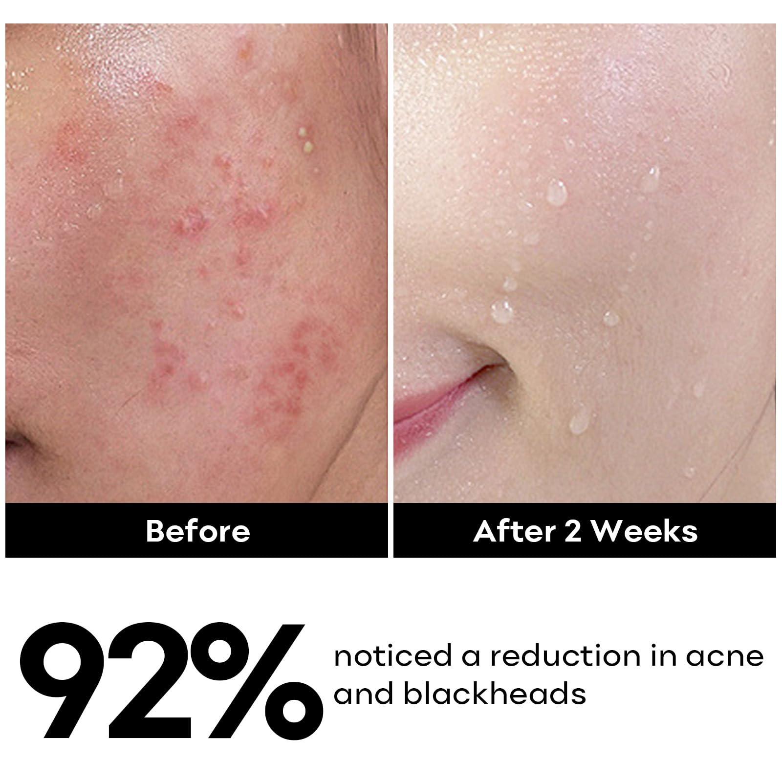 SYABO Salicylic Acid Face Cleanser, Daily Gentle Acne Cleansing Face Wash for Acne, Pore, Blackheads, Breakouts, Cleansing Gel for Oily & Sensitive Skin, 5.07 FL OZ