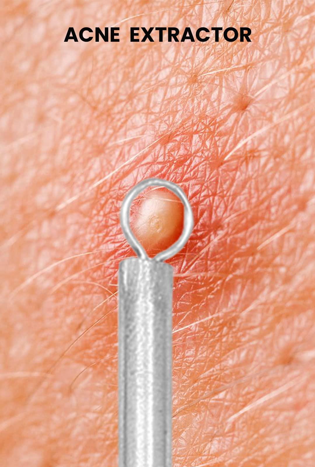 GMI-TWEEZERS GMI-TWEEZERS Blackhead Remover- 5 Piece Blackhead Extractor Tools Set for Pore Vacuum Extraction- Professional Grade Facial Cleaning & Blemish Removal- Blackhead Extractor Tools.