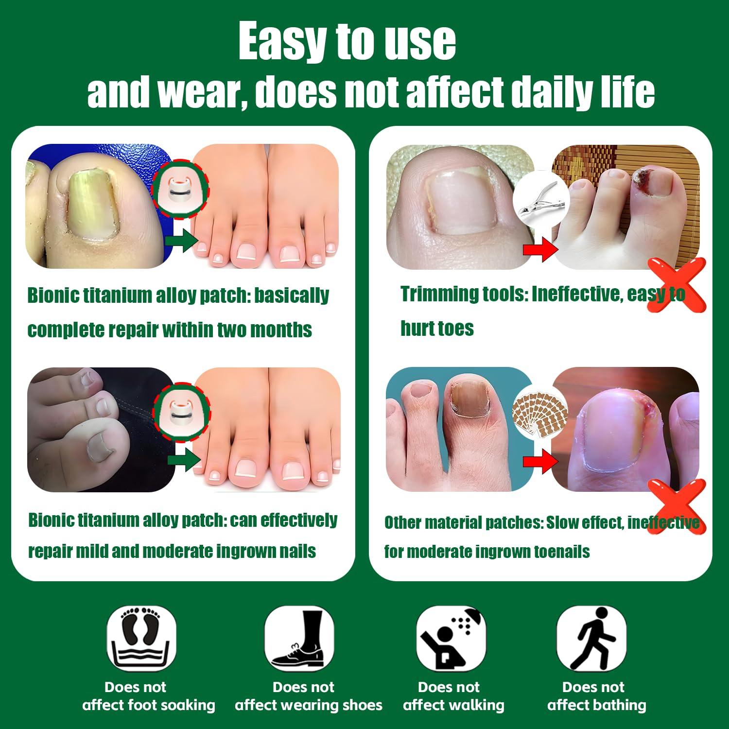 Truine Titanium Ingrown Toenail Corrector,Nail repair tools,Ingrown Toenail Treatment,Suitable for most people with ingrown toenailsIngrown Toenail Removal Kit,- Designed for Ingrown Toenail Repair10pcs