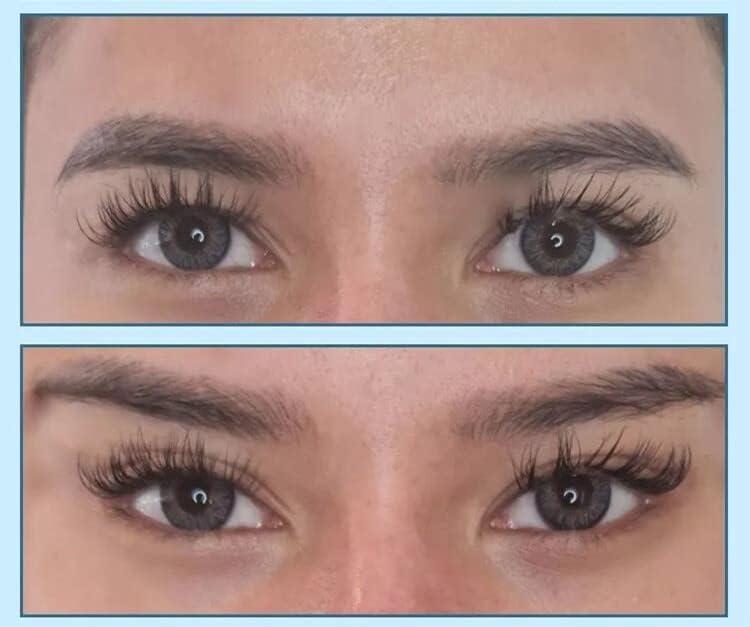 MatYas 20Pcs Pdo Cog Threads 4D 21G60mm for Fox Eye Lifting, W-Type, Barb Cog Threads