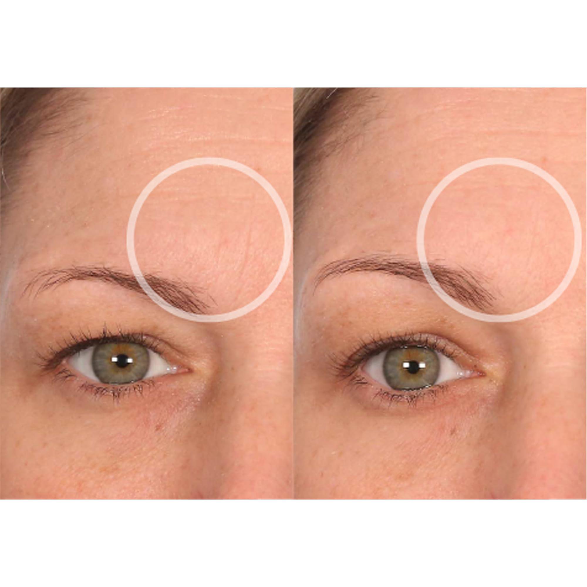 SiO SiO Beauty FaceLift - Reusable Anti-Wrinkle Patches for Neck, Forehead, Eye & Smile - Overnight Smoothing Silicone for Fine Lines, Wrinkles, and Aging