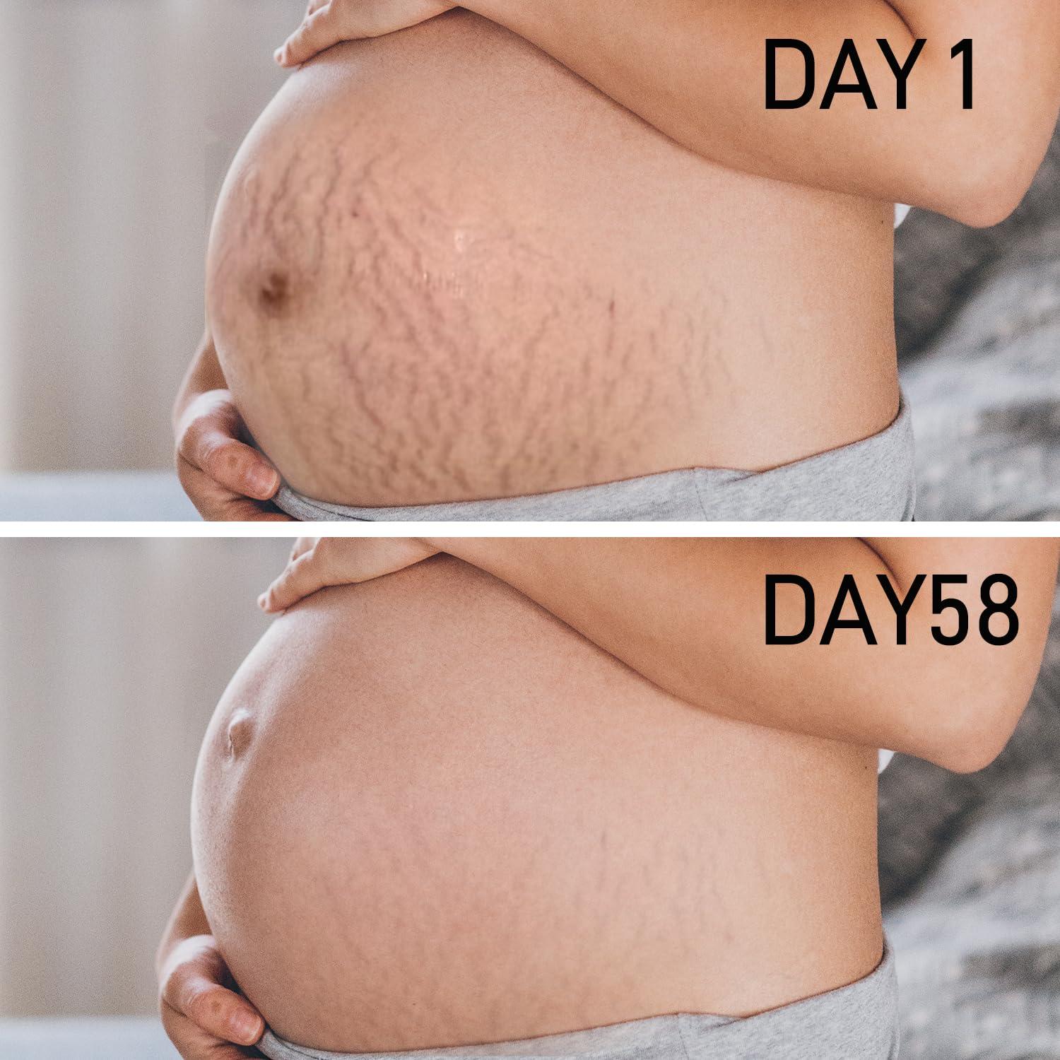 AOAO PEGO Stretch Marks Oil Maternity Body Oil for Stretch Marks Pregnancy Skin Care oil, Prevention & Reduction of Stretch Marks Pregnancy, 4.06 oz (2pcs)