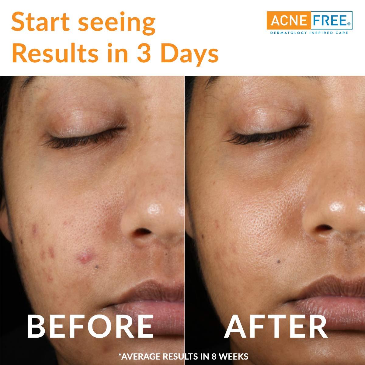 AcneFree Acnefree 24 Hour Acne Clearing System Kit (Pack of 6)