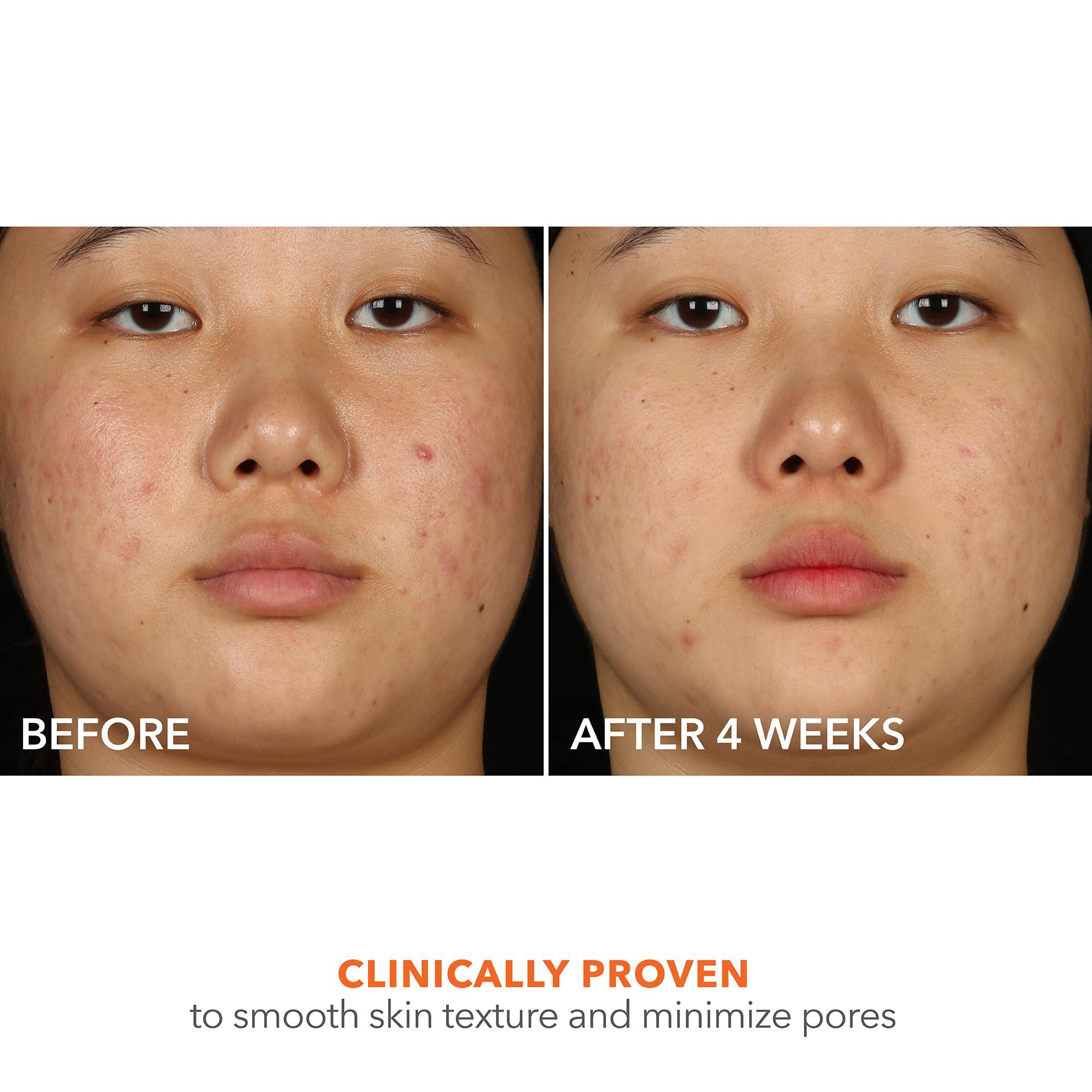 Dr Dennis Gross Dr Dennis Gross Alpha Beta 2% BHA+ Breakout Solution, Minimizes Pores, Clear & Prevent Breakouts, 5 Fl Oz