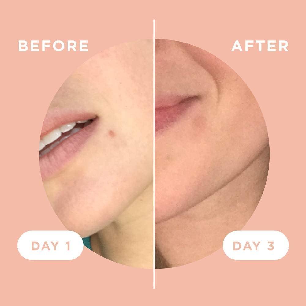 ZitSticka ZitSticka Killa Acne Patches for Face - World\'s Most Potent Pimple Patch with Fast-Acting Microdarts - Starts Working within 2 Hours for Deep, Early-Stage Zits & Blemish - 4 Count