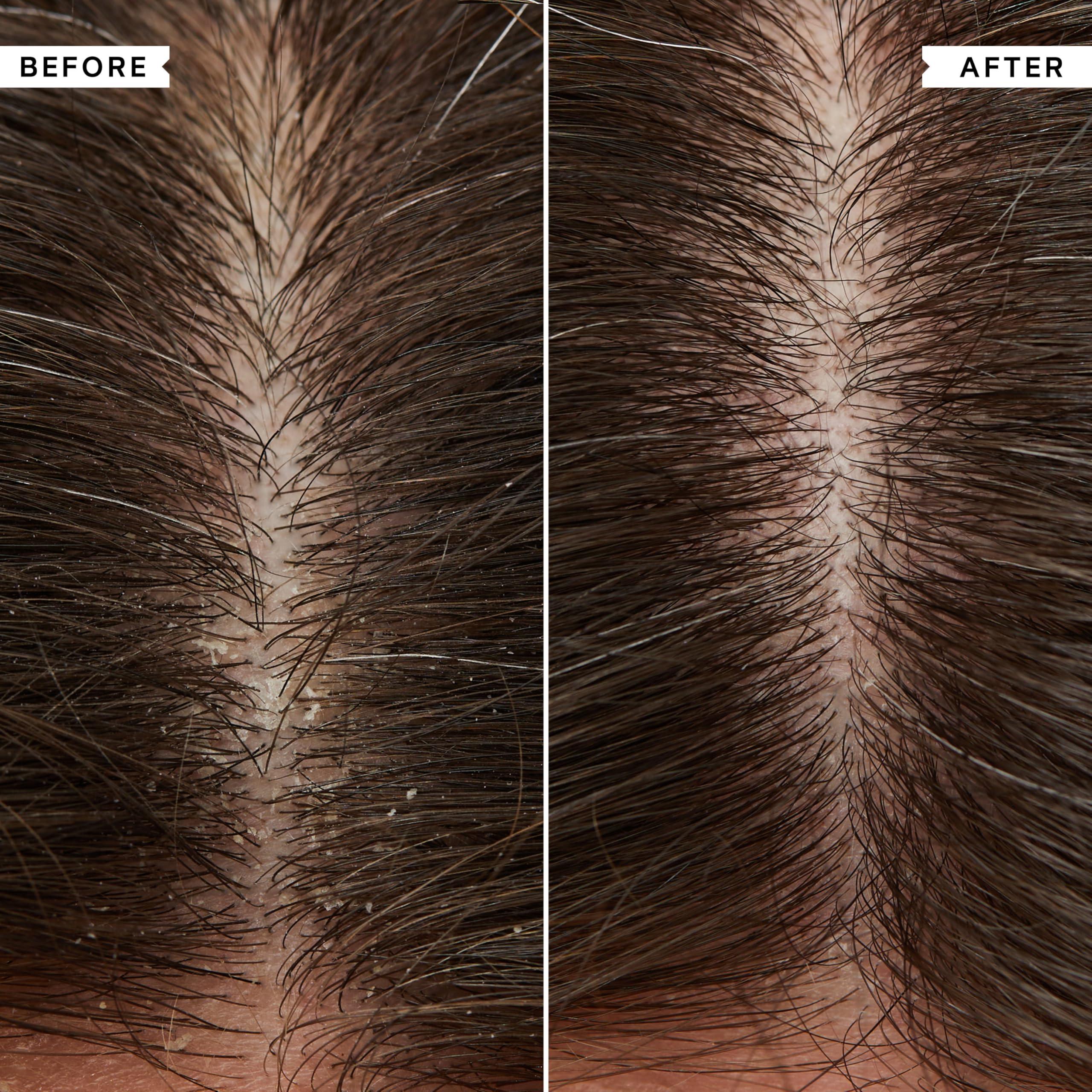 PHILIP KINGSLEY Flaky Scalp Shampoo and Conditioner Set for Dry Scalp Cleansing Hair Products Soothing, Soothes and Calms