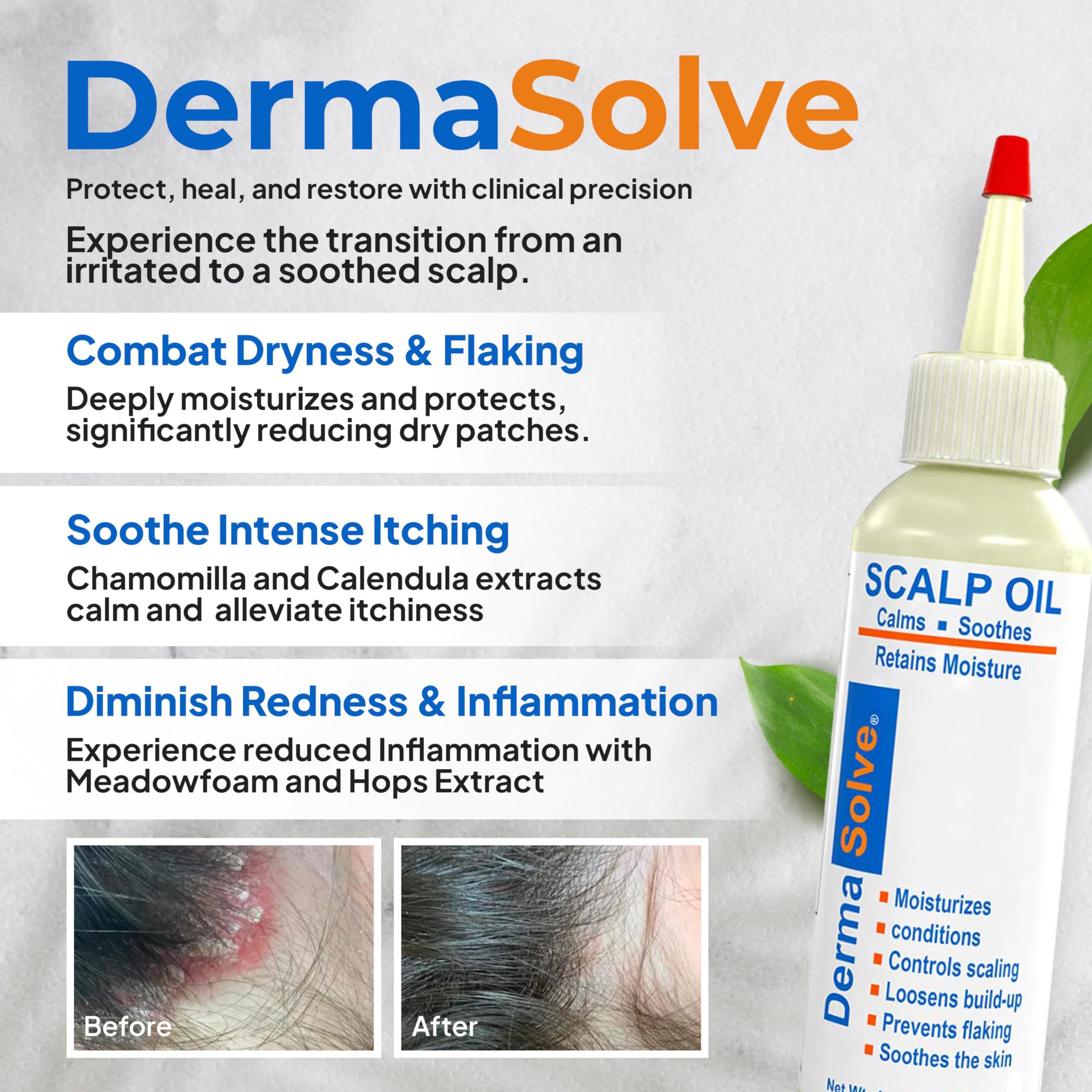 Dermasolve Dermasolve 4 oz Psoriasis, Seborrheic Dermatitis, & Dandruff Scalp Oil - Dermatologist Approved - Flaky Scalp Relief, Clinically Tested, Long-Lasting Itch-Free, High-Performance Formula