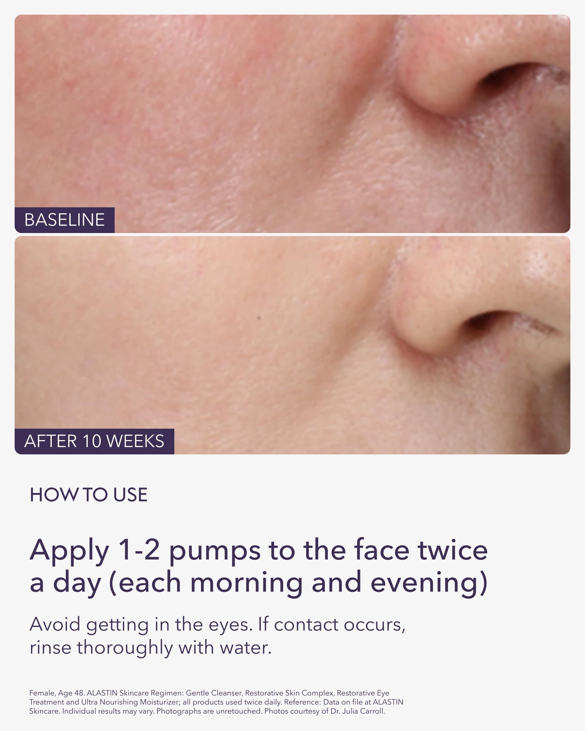 Alastin ALASTIN Skincare Restorative Skin Complex Anti-Aging Face Serum (1 oz) | Reduce Fine Lines & Wrinkles | With Niacinamide to Improve Texture