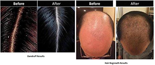 STOP ITCHING. START HEALING. Dr Marder’s A-D Psoriasis & Zinc Pyrithione Conditioner 6 FL OZ(180 mL) - Dermatologist Formulated - Stop Hair Loss + Promote Hair Growth - Treat Psoriasis hydrocortison