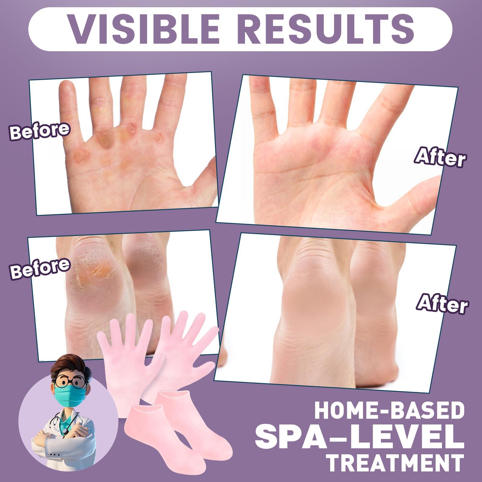 TEAWOO TEAWOO 2 Pairs Silicone Socks Gloves Set for Dry Cracked Feet Hands, Silicone Moisturizing Socks for Women, Hand Foot Care, Spa Gel Socks Gloves After Pedicure (Socks Fits Up to Size 10)