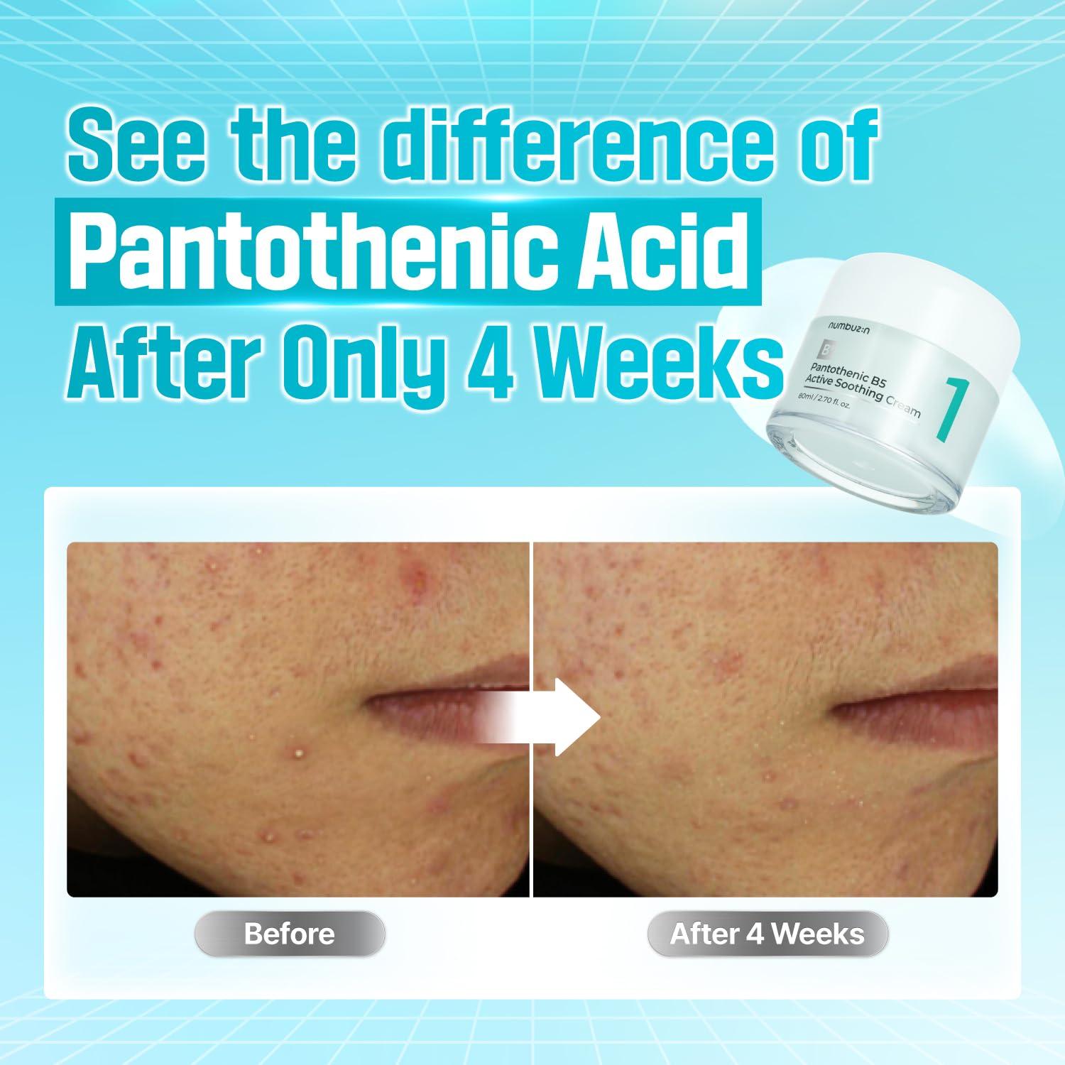 numbuzin numbuzin No.1 Cream | Pantothenic B5 Active Soothing Cream | Lightweight Hydrating Moisturizer, Pantothenic Acid, Niacinamide | Excess Oil Control, Soothes Acne | Non-Comedogenic | 2.70 fl. oz.