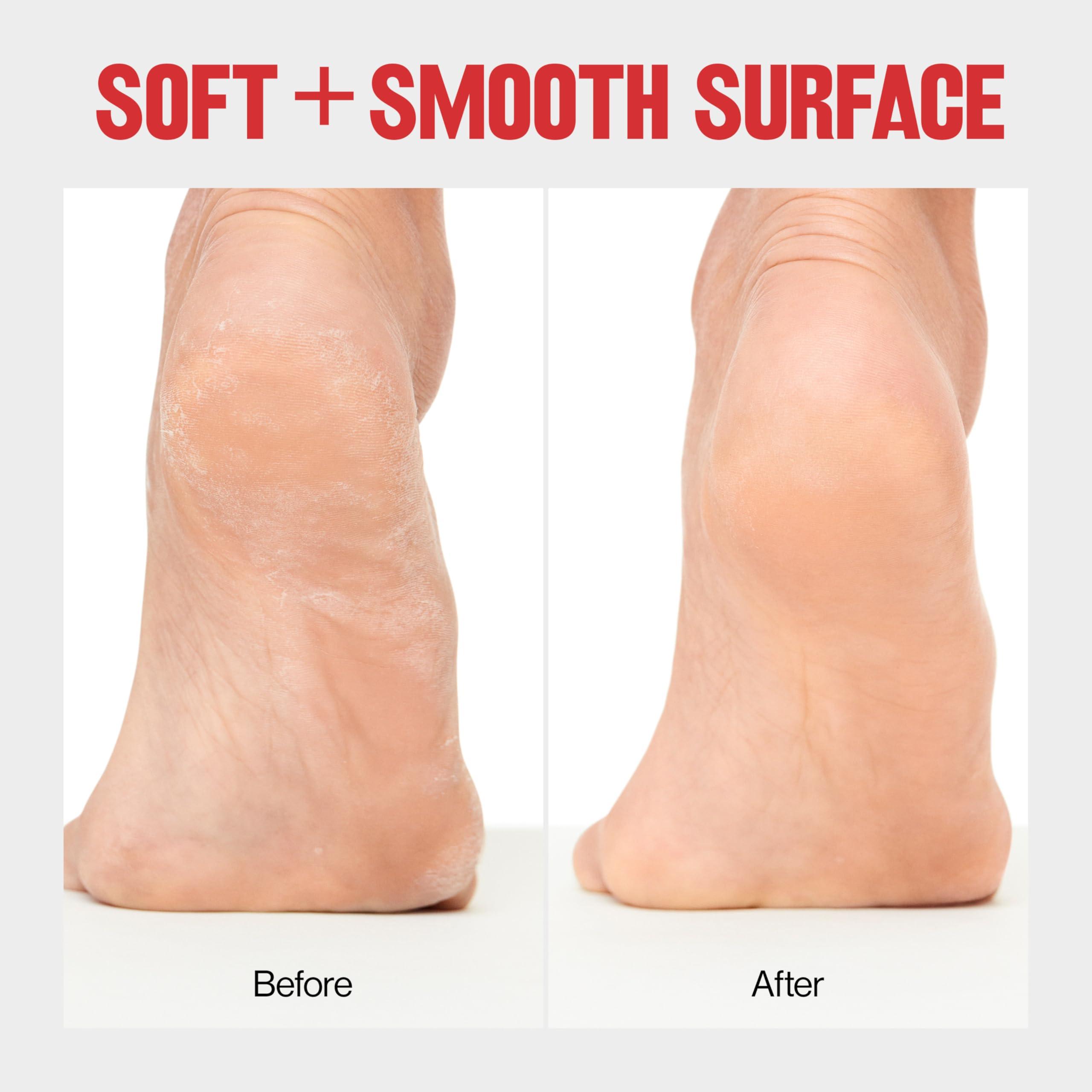 REVLON Revlon Callus Remover, Foot File for Wet or Dry Skin, Pedicure Tools,Gently Removed Callus and Dead Skin, Easy to Use (Pack of 1)