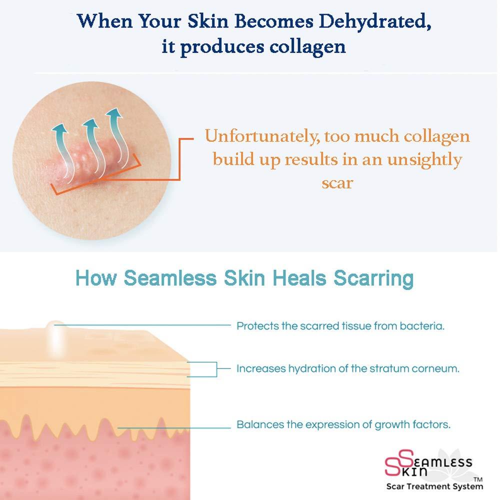 Seamless Skin SEAMLESS SKIN Scar Removal Treatment System (Set of 2) Silicone Gel Sheets - Mastopexy Areopexy Recovery - Breast Anchor Lift For Post Op Surgery & Stretch Marks Reducer