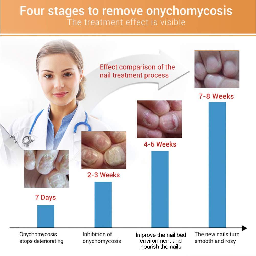 Salmue 12 ml Nail Care Solution Set, Powerful Nail Repair Essence, Nail Care Solution with Nail File, Nail Care Tool, Anti- Nail Treatment Effective Repair Solution