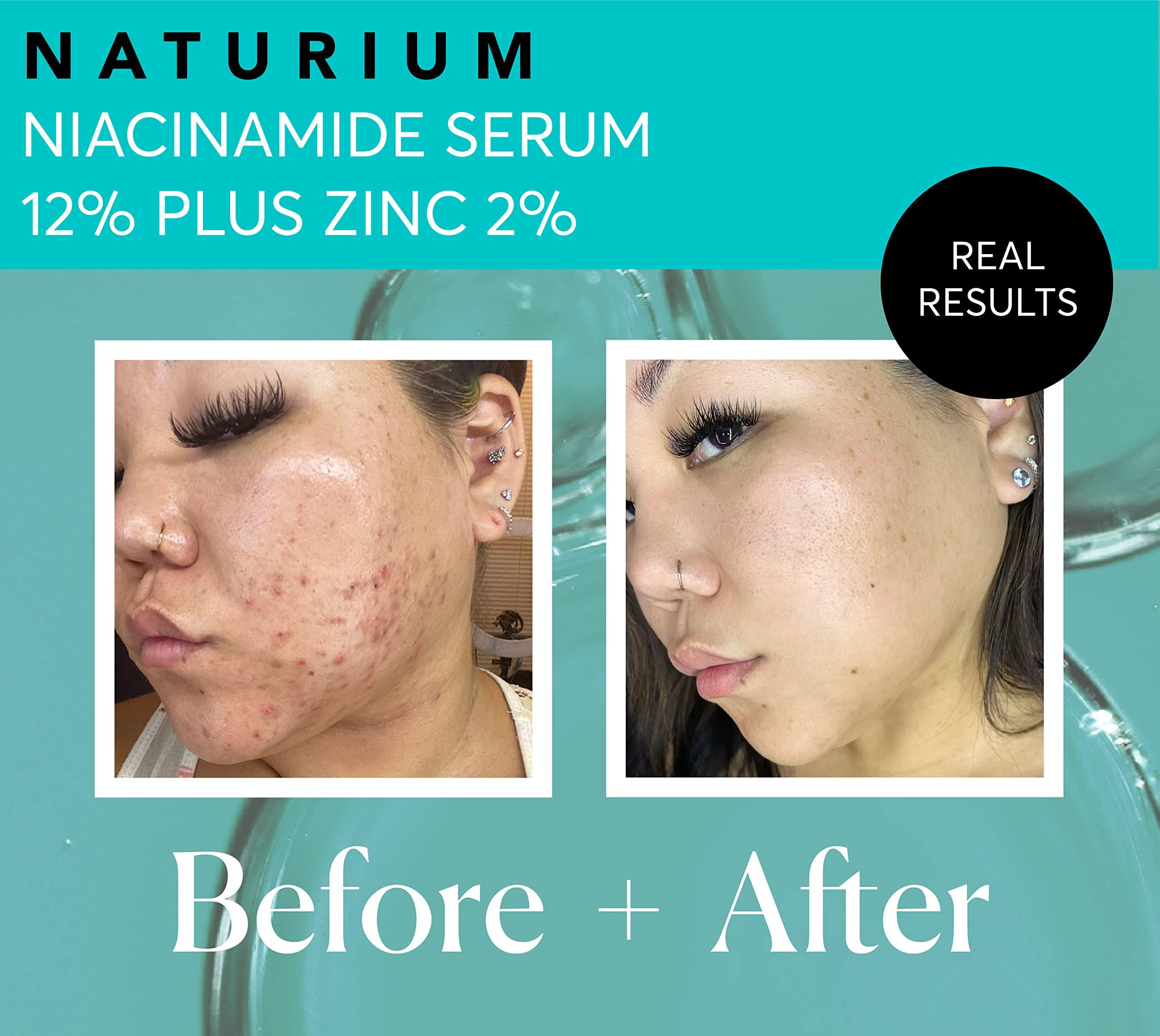 Naturium Naturium Niacinamide Face Serum 12% Plus Zinc 2%, Anti-Aging, Pore Minimizer & Dark Spot Corrector with Hyaluronic Acid & Vitamin E, Vegan & Cruelty-Free, 1 oz