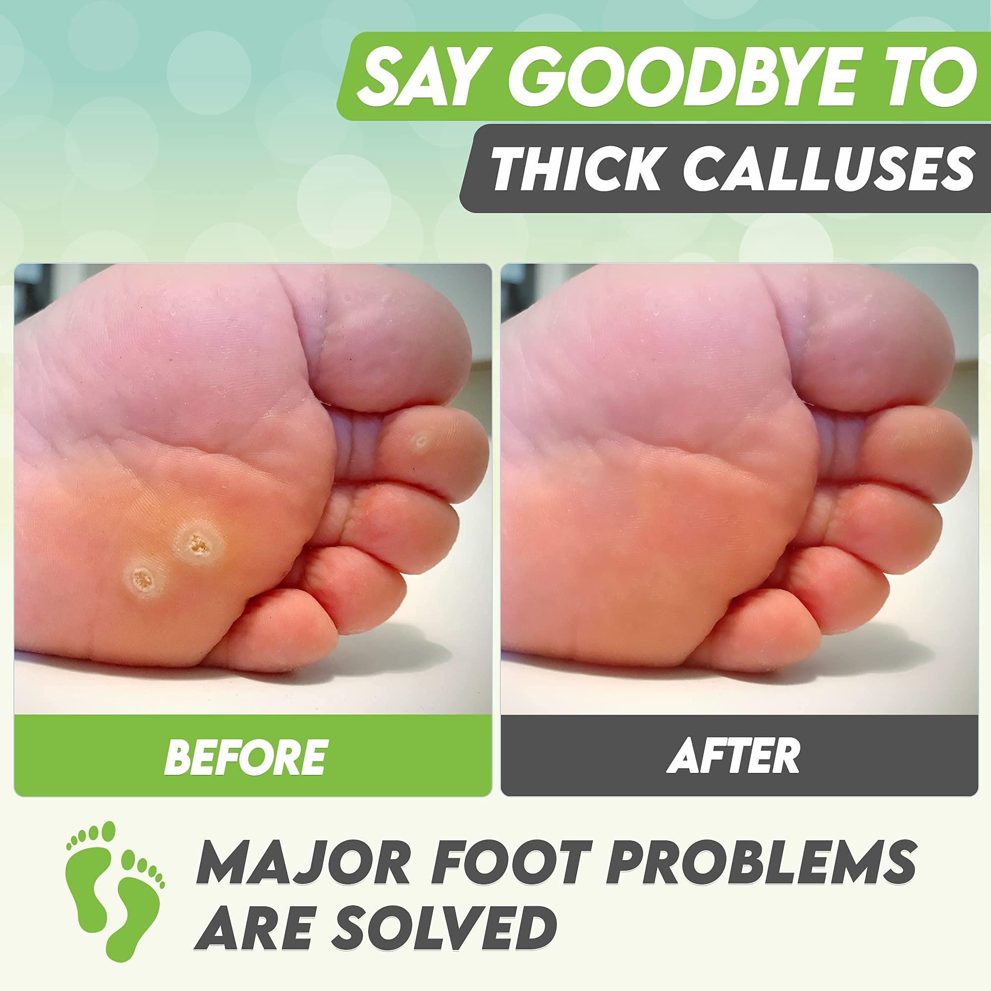 karma organic Foot Peel Mask Green Tea Moisturizing Exfoliating Foot Masks - Karma Organic Feet Peeling Masks for Dry ed Feet, Remove Dead Skin & Calluses - Removes & Repairs Rough Heels, Dry Toe Skin (Pack of 2)