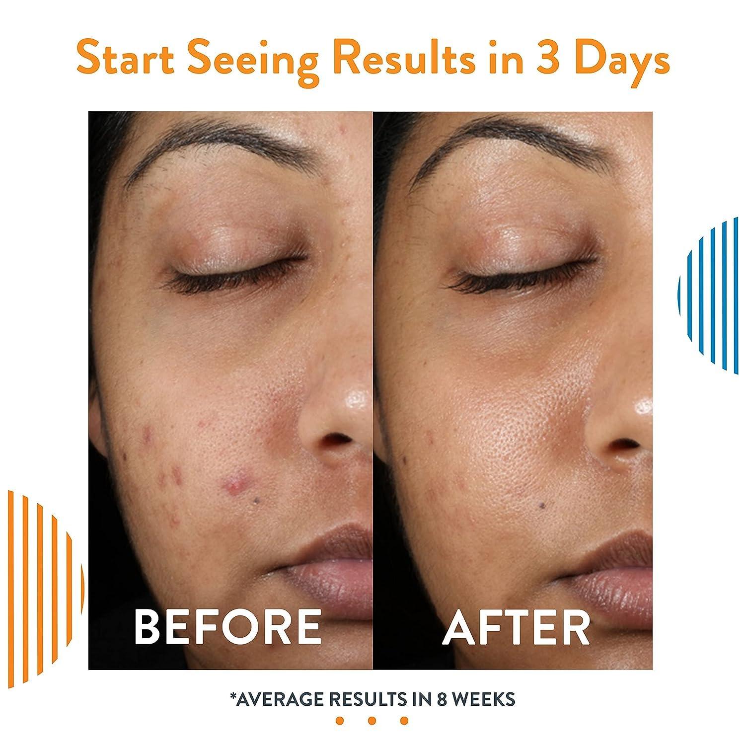 AcneFree AcneFree 3 Step 24 Hour Acne Treatment Kit - Clearing System W/Oil Cleanser, Witch Hazel Toner & Lotion - Acne Solution W/ Benzoyl Peroxide for Teens & Adults